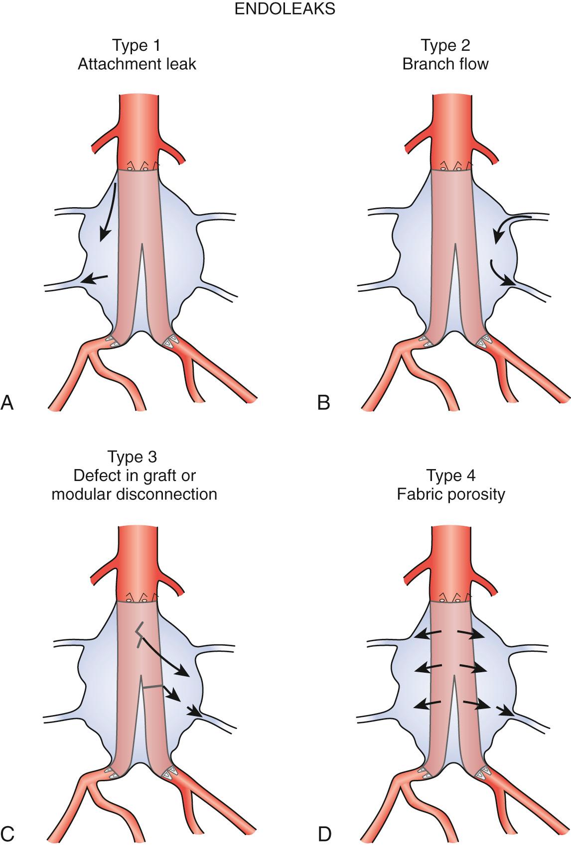 FIG. 12.9, Endoleaks of Abdominal Aortic Aneurysm After Endovascular Aneurysm Repair.