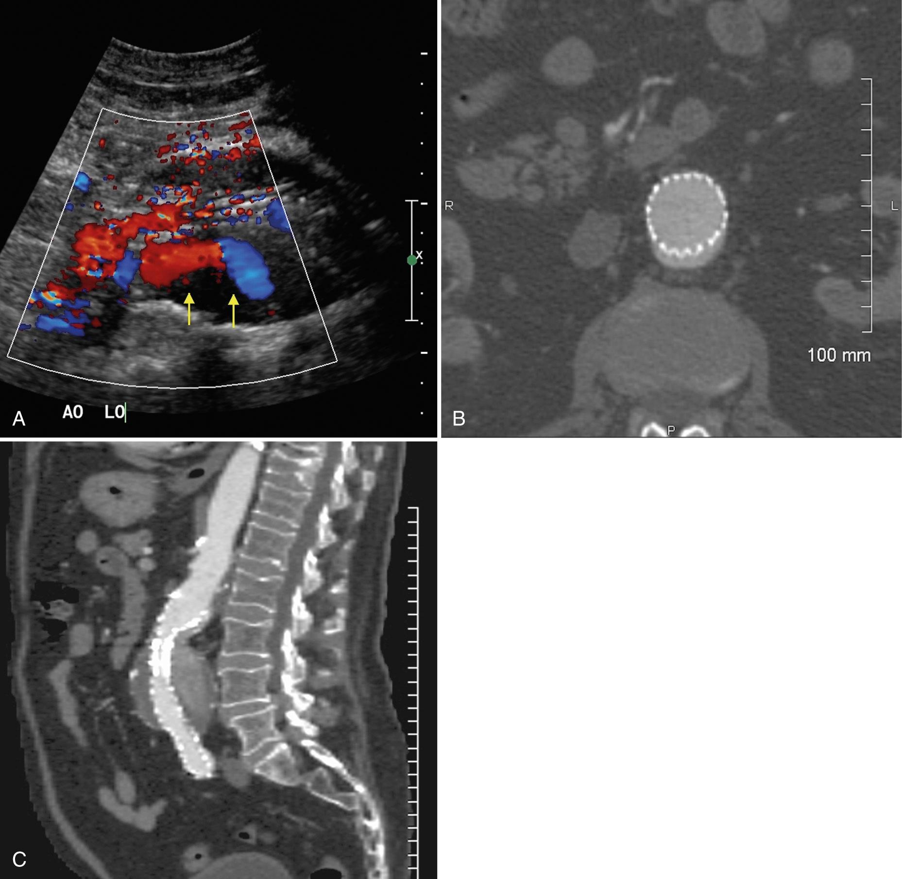 FIG. 12.10, Type 1 Endoleak.