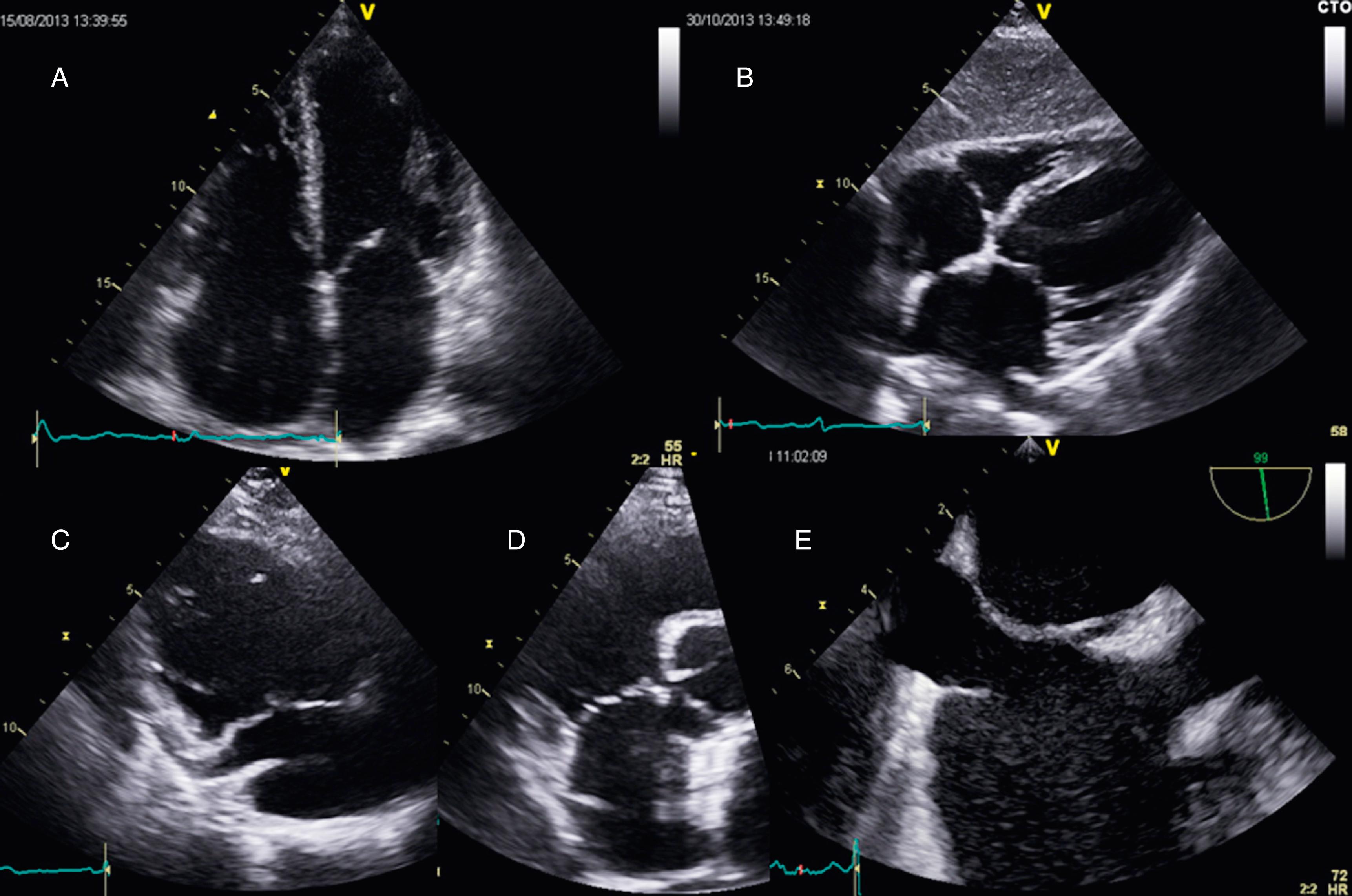 Figure 32.2, Standard two-dimensional views of the right atrium. A, Apical four-chamber view. B, Subcostal view. C, Parasternal short-axis view. D, Right ventricular inflow view. E, Transesophageal bicaval view.