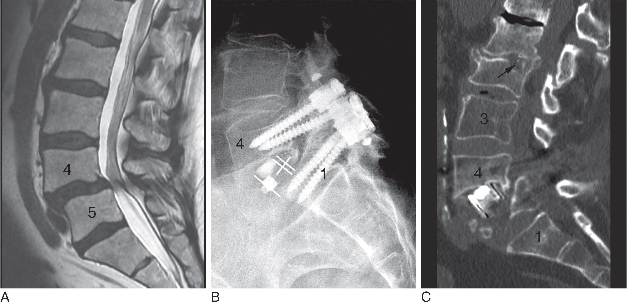 Fig. 2.1, (A) 67-year-old female with steroid-dependent rheumatoid arthritis, Sjögren syndrome, obesity, and diabetes mellitus presented to an outside hospital with neurogenic claudication. Sagittal magnetic resonance imaging demonstrated L4–L5 spondylolisthesis and spinal stenosis. She was treated with oblique lumbar interbody fusion at L4–L5. Postoperatively, she did well until she fell 4 months postoperatively and was found to have fractures at the inferior endplate of L4 and a complete fracture of the body of L5 with subsidence of the interbody cage toward S1. She presented with severe back and leg pain. Evaluation included a dual energy x-ray absorptiometry scan that showed a hip T-score of −3.4 and lab tests showed primary hyperparathyroidism. She is currently postoperative from parathyroidectomy. (B) Lateral postoperative radiograph after fall and subsidence of interbody cage and fracture of L5. (C) Computed tomography after fall demonstrating poor bone quality, fractures of the endplates of L2 and L4, and L5 vertebral body with cage subsidence. A region of interest of L3 showed mean Hounsfield units of 84 indicating osteoporosis.