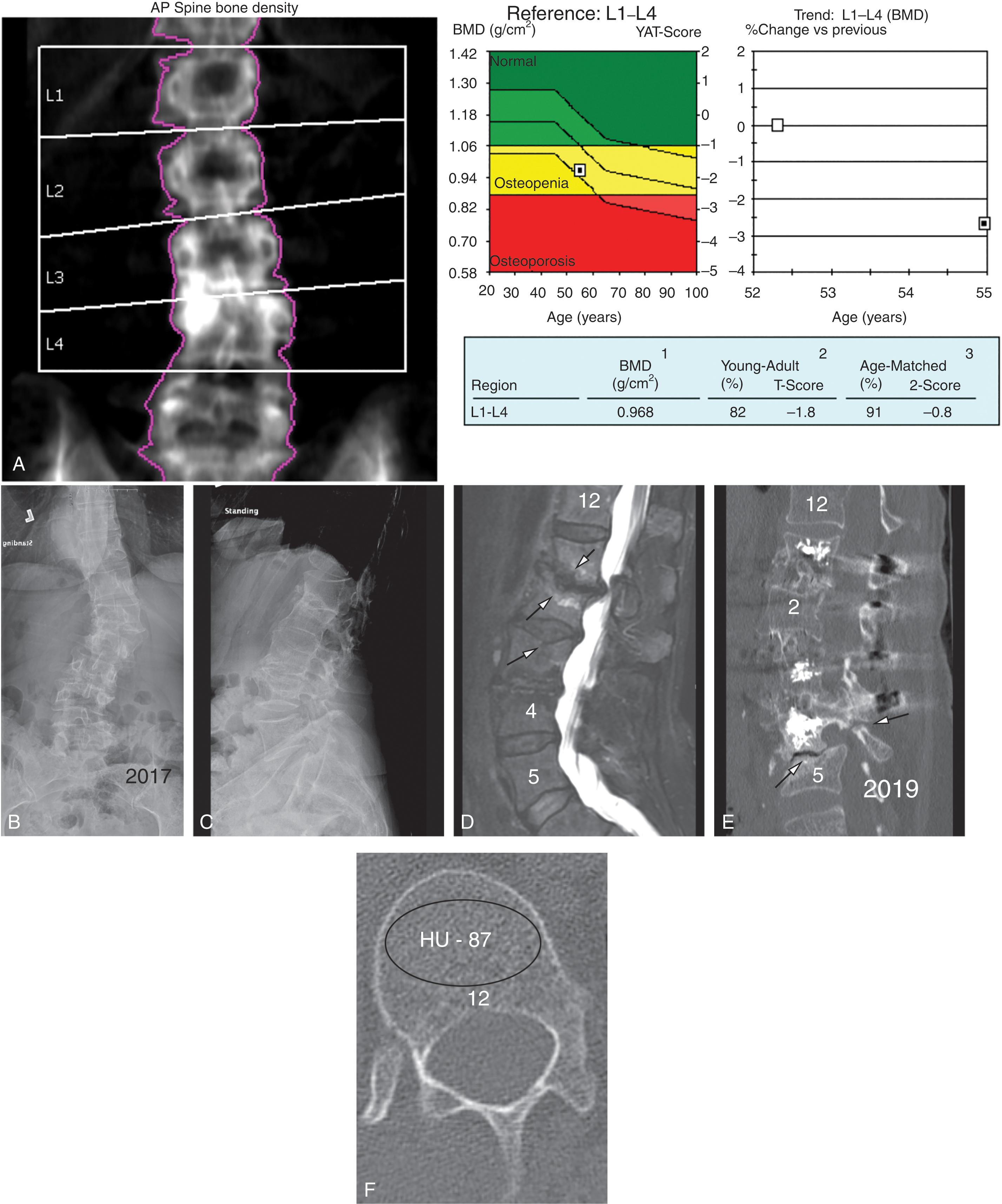 Fig. 2.2, (A) In 2009, a 55-year-old steroid-dependent female with Sjögren syndrome underwent a dual energy x-ray absorptiometry scan of the lumbar spine. The diagnosis was osteopenia based on a T-score of –1.8. This was incorrectly interpreted since the degenerative changes at L3–L4 should not have been included in the measurement. The report at L1–L2, where the degenerative changes were eliminated, had a T-score of –3.3 indicating osteoporosis. A small degree of scoliosis was noted and was centered at L3–L4. She was prescribed a course of alendronate and 24 months of teriparatide. (B) She presented in 2017 with pain, progressive scoliosis, and height loss. An anteroposterior (AP) radiograph shows 27 degrees scoliosis with apex at L1–L2. (C) Lateral image showing severe disc collapse at L1–L2 and concave superior endplates of L3 and L4 suggesting osteoporosis fractures. (D) Sagittal T2 magnetic resonance image showing stenosis at L1–L2 with severe collapse of disc space. The arrow points out erosion or fracture of the vertebral endplates of L1, L2, and L3. (E) The patient was treated with L1–L4 lateral interbody fusions with cages and allograft and posterior instrumentation with cemented pedicle screws. She did well for 4 months and presented with increasing pain and an inability to walk. Sagittal computed tomography (CT) showed pars fracture of L4, spondylolisthesis of L4–L5, and fracture of the superior endplate of L5. Dual energy x-ray absorptiometry was performed showing osteopenia of the right hip. However, her fracture risk assessment tool scores were 3.2% and 40.5% for 10-year hip and major osteoporotic fracture risk, respectively, indicating severe osteoporosis. (F) Axial CT of T12 with Hounsfield units of 87, indicating osteoporosis.