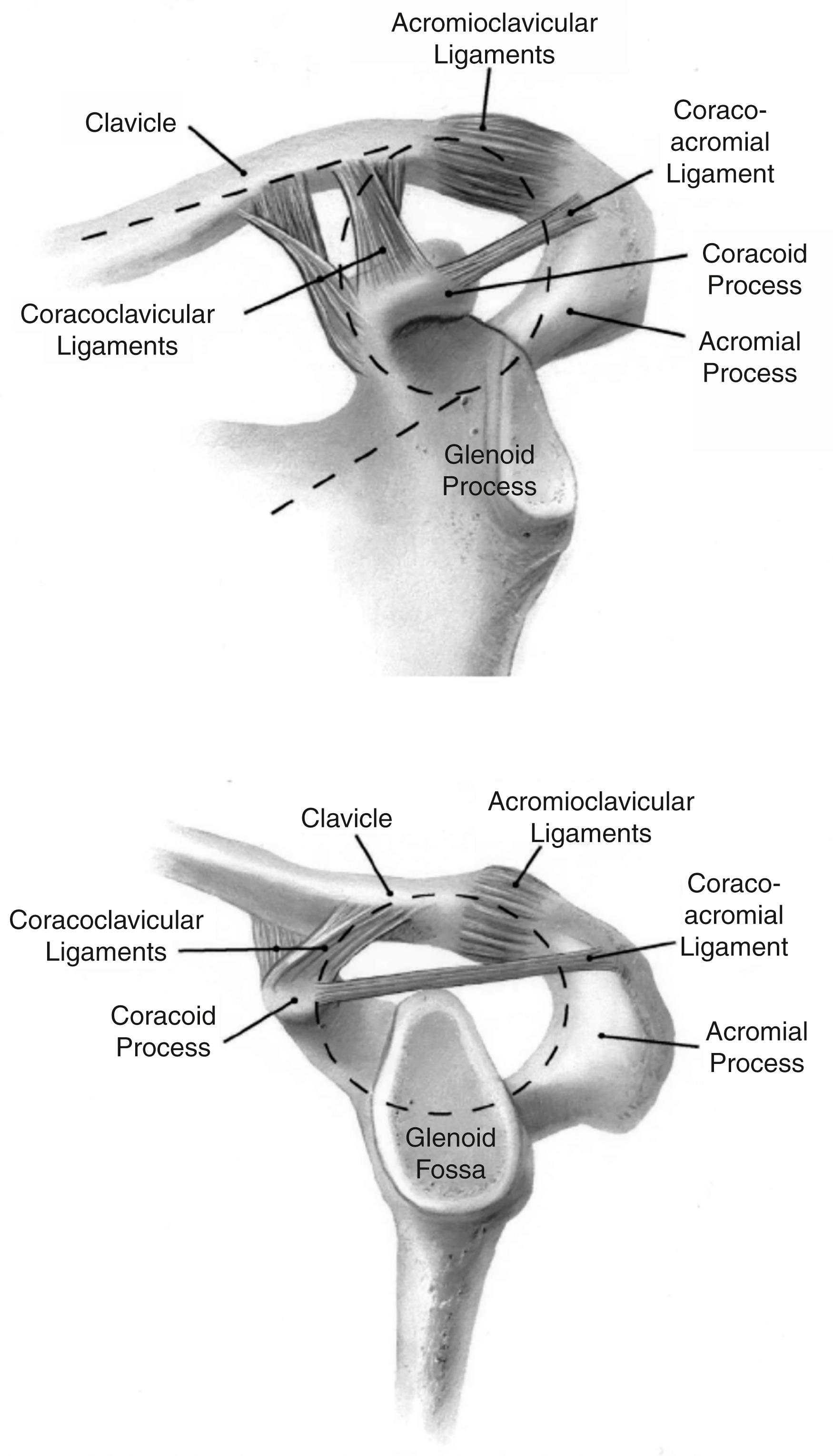 Fig. 15.1, The superior shoulder suspensory complex described by Goss characterizes the osseoligamentous ring that includes the glenoid, coracoid, clavicle, and acromion process along with the connecting soft tissues between these structures (i.e., coracoclavicular ligament and acromioclavicular joint capsule).