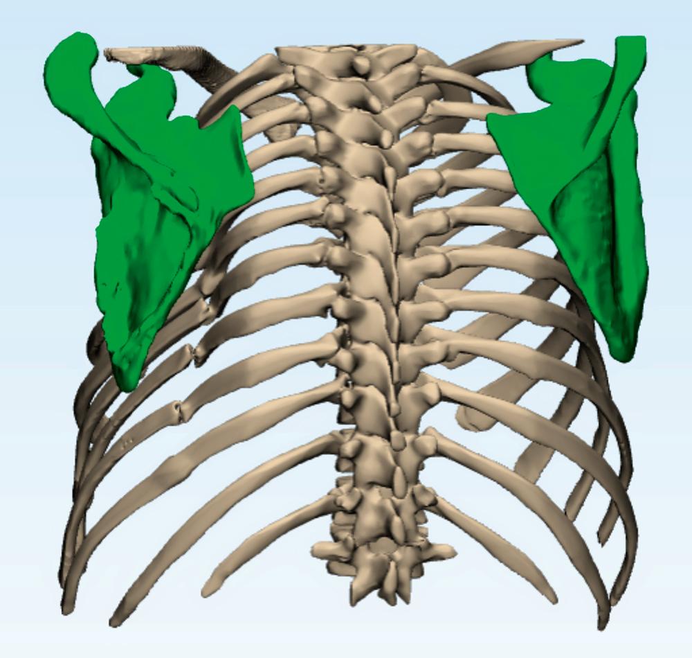 Fig. 15.2, A three-dimensional computed tomography reconstruction several years following successful open reduction and internal fixation of the patient’s left scapula, illustrating the persistent deformity of the thoracic cage with malunions of ribs 3 through 7 and nonunions of ribs 8 and 9. The outlines of medial and lateral border plates on the healed scapula are visible. This patient has ongoing functional limitation and pain due to the underlying deformity of the scapulothoracic joint on which the scapula attempts to glide during range of motion of the left upper extremity. Retraction and protraction of the scapula are most symptomatic.