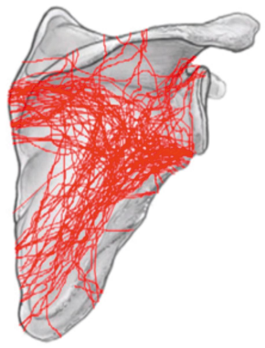 Fig. 15.5, From the work of Armitage et al., a cohort of 90 operative scapula fractures including all extra-articular fractures that entered (exited) the lateral border inferior to the glenoid were overlaid to create a fracture heat map.