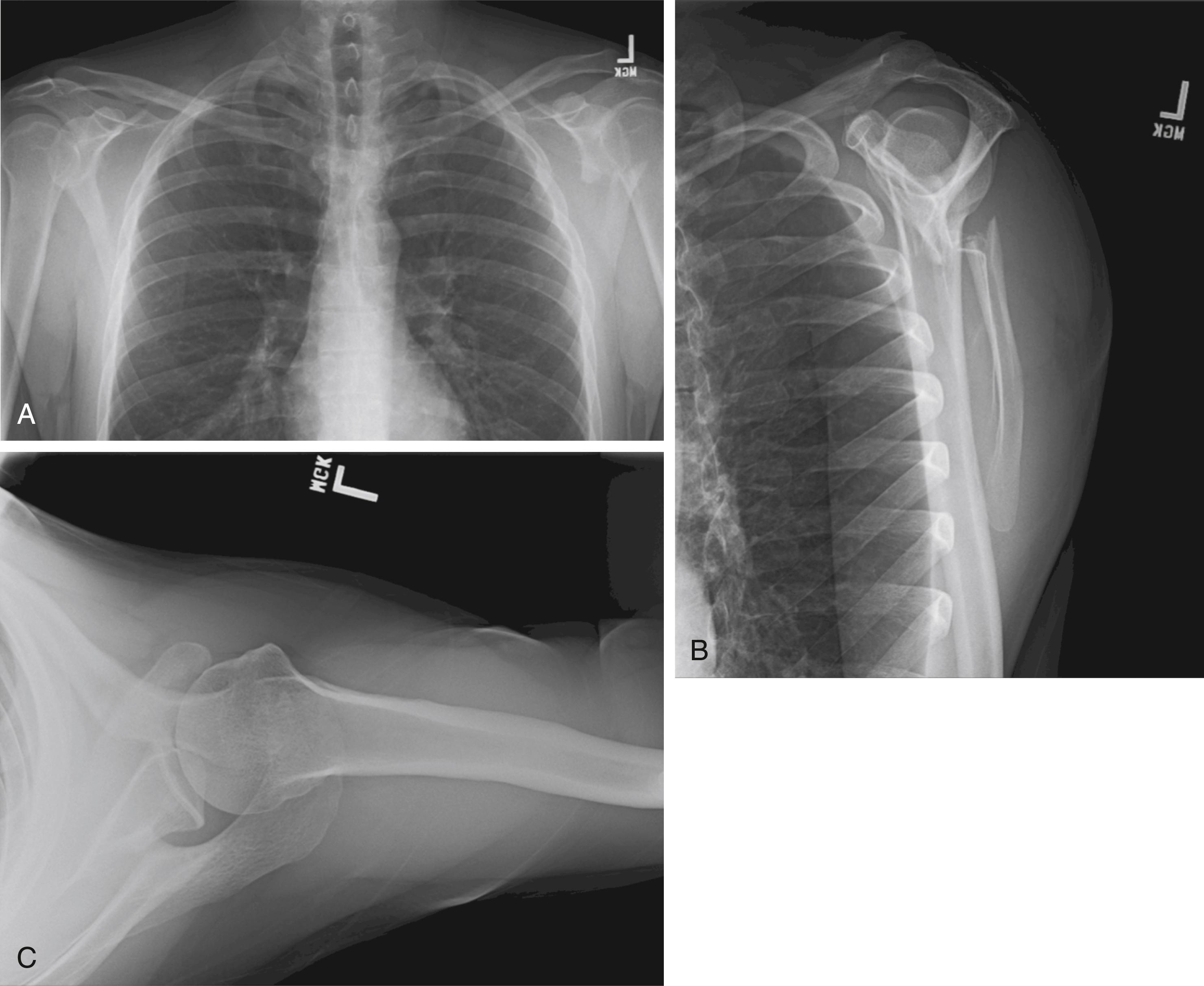 Fig. 15.8, Injury radiographs of an extra-articular left scapula fracture. (A) Anteroposterior view, (B) scapula Y view, and (C) axillary view of the left scapula.
