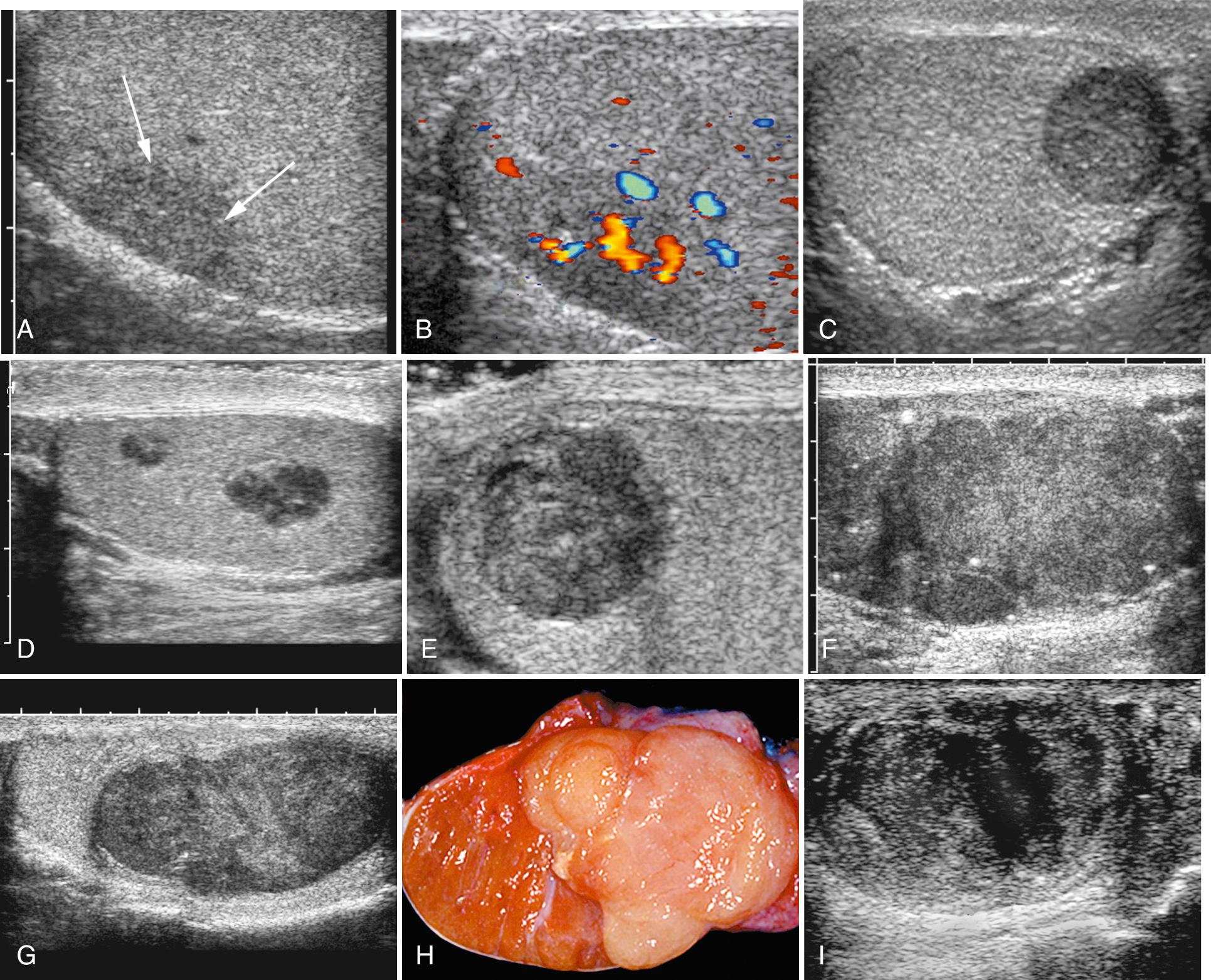 FIG. 22.5, Seminoma: Spectrum of Appearances.