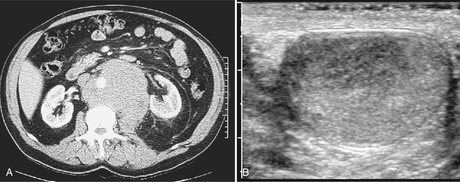 FIG. 22.7, Occult Testicular Seminoma With Retroperitoneal Metastases.