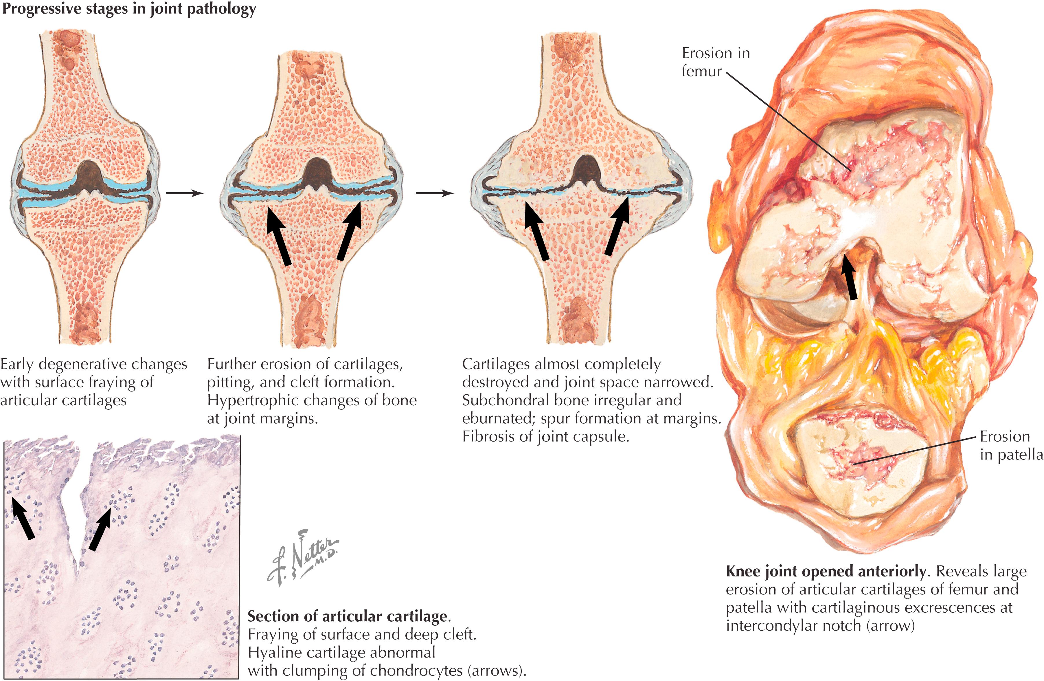 Figure 13.1, Osteoarthritis