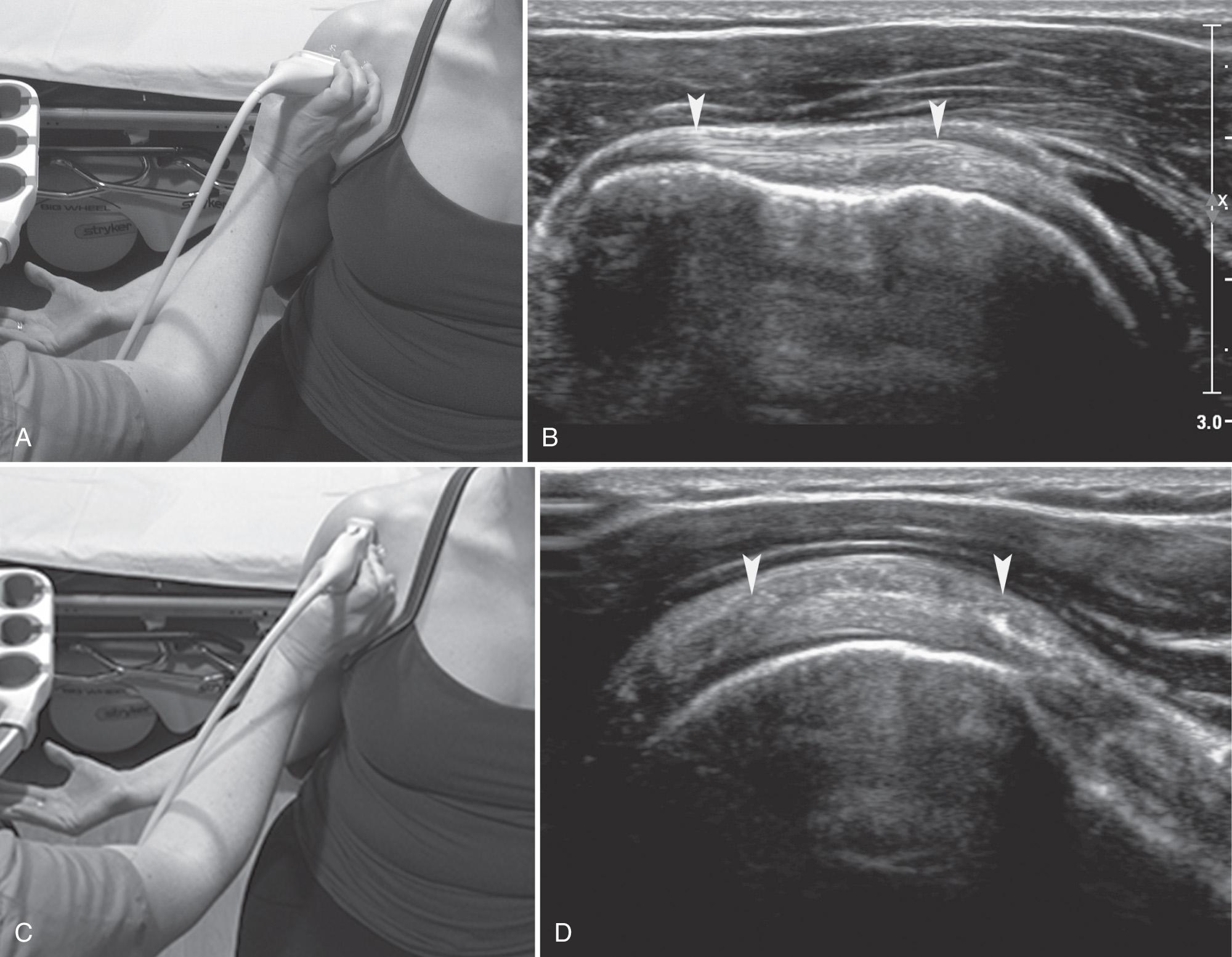 FIG. 24.5, Subscapularis Tendon.