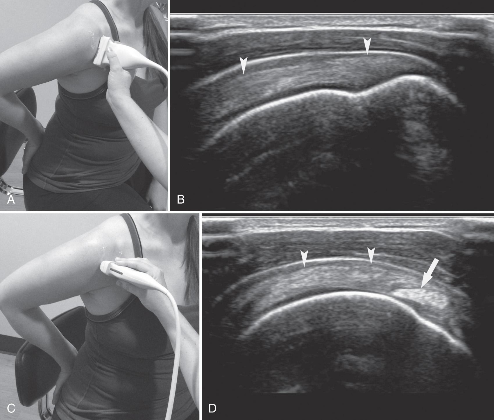 FIG. 24.7, Supraspinatus Tendon and Modified Crass Position.