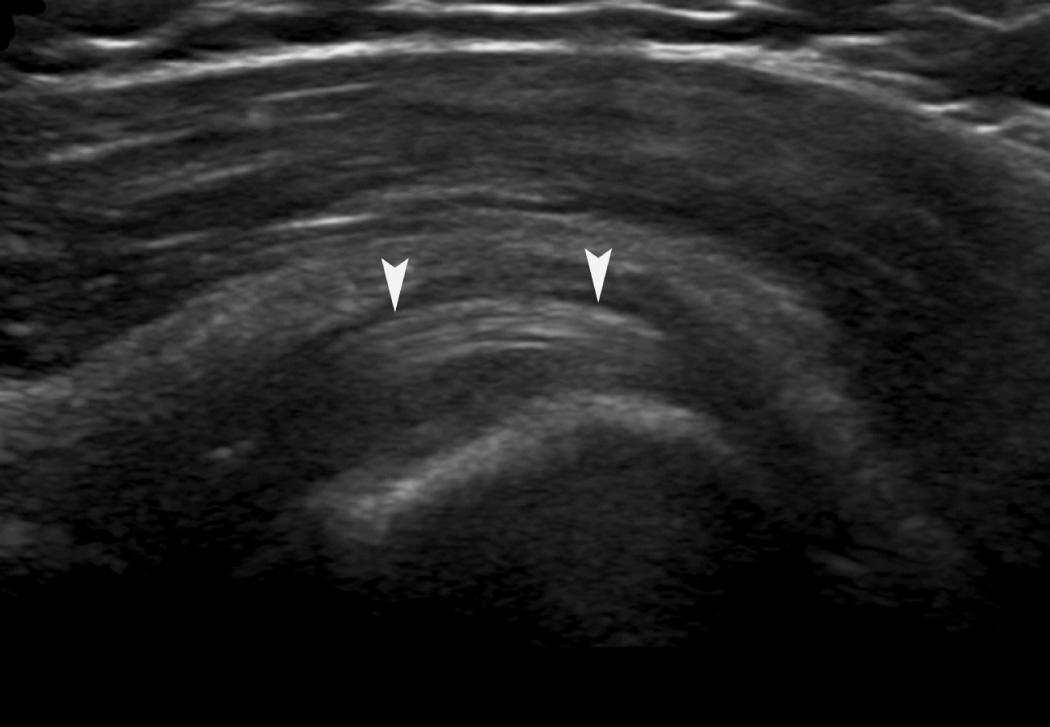 FIG. 24.8, Long-Axis Biceps Tendon Image, With Shoulder in the Modified Crass Position.