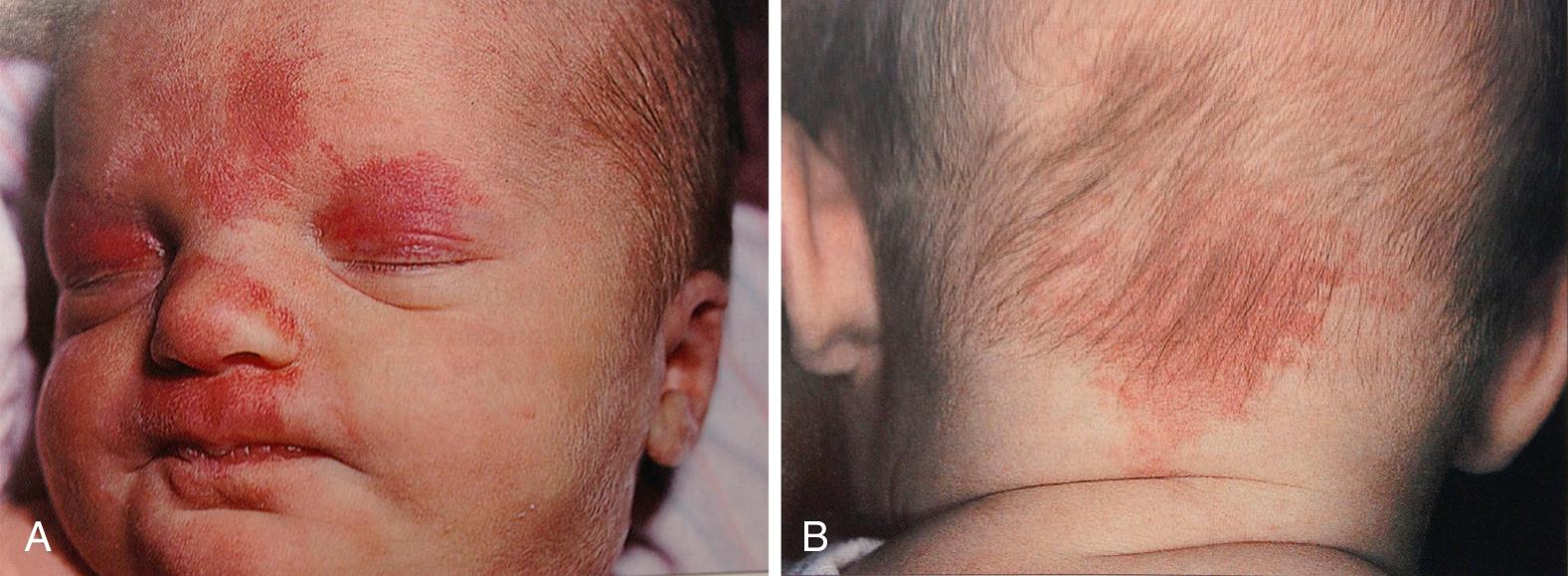 Fig. 94.4, Capillary ectasias or transient macular stains (salmon patches). A, Also called a nevus simplex, these lesions appear on the glabella, eyelids, nose, and upper lip. B , The most common location for a nevus simplex is the nape of the neck.