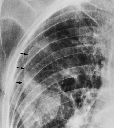 FIGURE 9-44, The axillary fold simulating a pneumothorax.