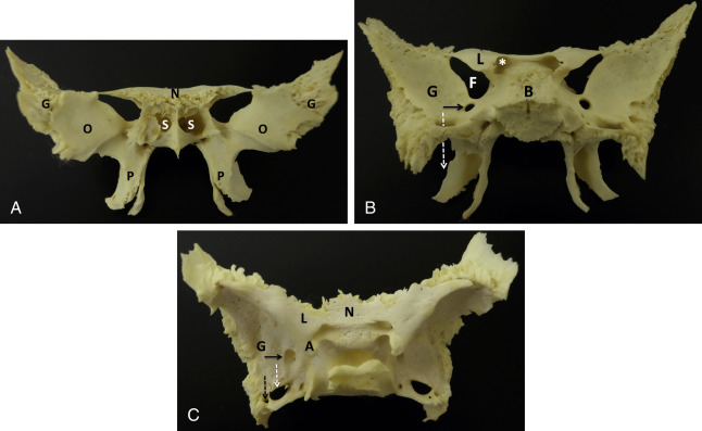 Fig. 3.1, Anatomy of a sphenoid bone specimen. (A) Frontal view shows the greater sphenoid wings (G) and pterygoid plates (P) resembling the wings of a bird with extended limbs, respectively. The sphenoid sinus (S), posterior wall of the orbit (O), and planum sphenoidale (N) are also highlighted. (B) Posterior view shows the greater wing (G), lesser wing (L), and body (B) of the sphenoid bone. The superior orbital fissure (F), optic canal ( asterisk ), foramen rotundum ( black arrow ), and foramen ovale ( dashed white arrow through the foramen) are highlighted. (C) Superior view shows the lesser wing (L), planum sphenoidale (N), greater wing (G), anterior clinoid process (A), foramen ovale ( dashed white arrow ), foramen spinosum ( dashed black arrow ), and foramen rotundum ( black arrow ).