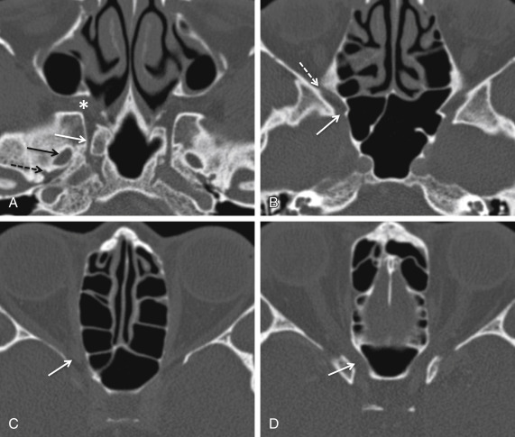 Fig. 3.2, Normal sphenoid bone foramina. CT face axial bone windows from inferior to superior (A – D) . The most inferior section shows the vidian canal ( solid white arrow ), foramen ovale ( solid black arrow in A ), and foramen spinosum ( dashed black arrow in A ). These foramina are traversed by the vidian nerve, mandibular division of the trigeminal nerve (V3), and the middle meningeal artery, respectively. In (B) the foramen rotundum ( solid white arrow ) is seen superior and lateral to the vidian canal and transmits the maxillary division of the trigeminal nerve (V2) into the pterygopalatine fossa ( asterisk in A ). The inferior orbital fissure ( dashed white arrow in B ) is also seen at the level of the foramen rotundum. In (C) the superior orbital fissure is highlighted ( solid white arrow ). This is a major conduit between the cavernous sinus and orbit and transmits cranial nerves III, IV, and VI along with several other vessels and nerves. The most superior section (D) shows the optic canal, which transmits the optic nerve and ophthalmic artery.