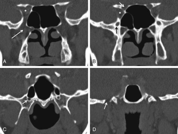 Fig. 3.3, Normal sphenoid bone foramina. CT face coronal bone windows from anterior to posterior (A – D) . The most anterior section (A) shows the pterygopalatine fossa ( solid white arrow ) and orbital apex ( asterisk ). More posteriorly (B) the separate optic canal ( solid white arrow ), superior orbital fissure ( asterisk ), and foramen rotundum ( solid black arrow ) are noted. The vidian canal is located inferomedial to the foramen rotundum and highlighted more posteriorly in ( C , solid white arrow ). The most posterior section shows the vertically orientated foramen ovale ( D , solid white arrow ), which transmits the mandibular division of the trigeminal nerve.