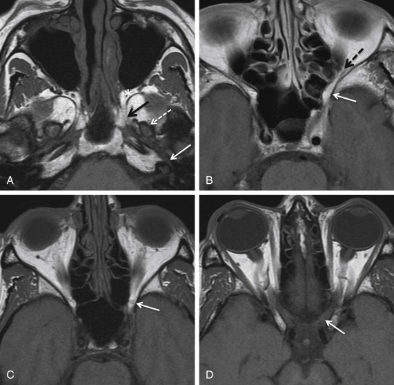 Fig. 3.4, Normal sphenoid bone foramina. MRI axial T1-weighted (T1W) sequences from inferior to superior (A – D) . The most inferior section shows the vidian canal ( solid black arrow ) with the greater superficial petrosal nerve seen more posteriorly arising from the geniculate ganglion of the facial nerve ( solid white arrow ). Foramen ovale transmitting the mandibular division of the trigeminal nerve is also seen ( dashed white arrow in A ). In (B) the foramen rotundum ( solid white arrow ) is noted superior and lateral to the vidian canal and transmits the maxillary division of the trigeminal nerve (V2) into the pterygopalatine fossa ( asterisk in A , normal appearance with T1W hyperintense fat signal within). The inferior orbital fissure ( dashed black arrow in B ) is also seen at the level of the foramen rotundum. In (C) the superior orbital fissure is highlighted ( solid white arrow ). This is a major conduit between the cavernous sinus and orbit and contains T1W hyperintense fat. The most superior section ( solid white arrow in D ) shows the optic canal, which transmits the optic nerve and ophthalmic artery. On MRI, T1W sequences are useful for assessing for extra- or intracranial spread of disease through the foramina. T1W hyperintense fat signal is seen most prominently at the pterygopalatine fossa, superior orbital fissure, and orbital apex. If this signal is lost, then underlying disease may be present and postcontrast sequences should be carefully interrogated.