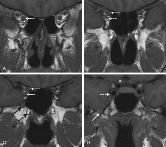 Fig. 3.5, Normal sphenoid bone foramina. MRI face coronal T1-weighted (T1W) sequences from anterior to posterior (A – D) . The most anterior section (A) shows the optic nerve ( solid white arrow ) at the orbital apex surrounded by the extraocular muscles and T1W hyperintense orbital fat. More posteriorly the optic nerve is seen entering the optic canal ( solid white arrows in B and C ) with the extraocular muscles and cranial nerves III, IV, and VI converging at the superior orbital fissure ( dashed white arrows in B and C ). The foramen rotundum containing the maxillary division of the trigeminal nerve (V2, solid black arrow in C ) and the inferomedial vidian canal and internal vidian nerve ( dashed black arrow in C ) are noted at the sphenoid body. The most posterior section shows the vertically orientated foramen ovale and mandibular division of the trigeminal nerve (V3, solid white arrow in D ). V3 extends from the Gasserian or semilunar ganglion and does not enter the cavernous sinus ( dashed arrow in D ). The prechiasmatic optic nerve is also noted ( asterisk in D ).