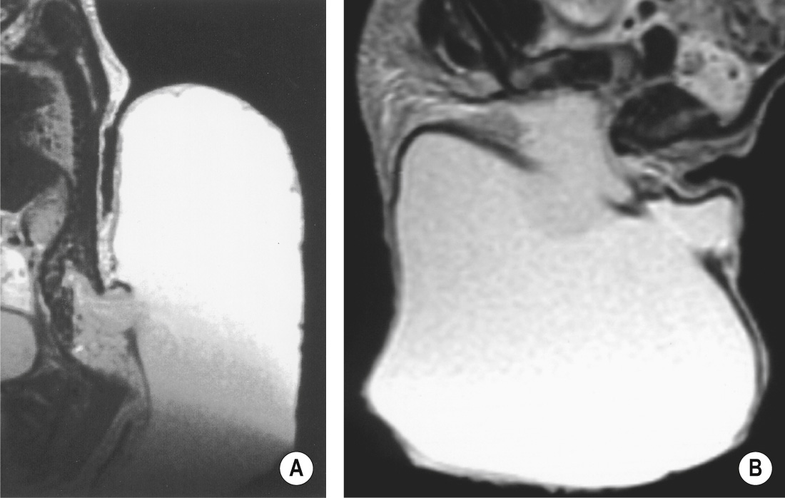 Meningocele. (A) A huge CSF collection spills out through a defect in the spinal canal. (B) T2WI through the lumbosacral region shows no solid material within the fluid herniating through the dysraphic spine. +