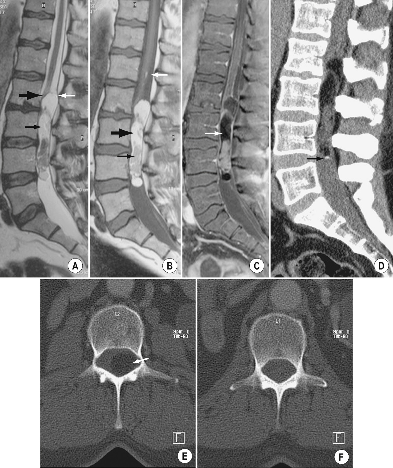 Intradural extramedullary dermoid in a 52-year-old man with backache, leg paresthesia, and anal incontinence. A, Sagittal T2W MR image depicts a large cystic intradural mass (thin black arrow) in the region of the conus medullaris and cauda equina. Note displacement of the dura mater (thin white arrow) posteriorly and the conus medullaris (thick black arrow) anteriorly. B, Sagittal T1W MR image shows an isointense solid component (thin black arrow) and a hyperintense fatty component (thick black arrow). A small fatty droplet is also visible in the subarachnoidal space (thin white arrow). C, Sagittal T1W MR image with fat suppression and administration of gadolinium affi rms the presence of fat (arrow) that is suppressed with this sequence. D, The sagittal CT image shows an additional small calcifi cation (arrow). E, The axial CT with bone window depicts a spinal canal widening in the region of the hypodense fatty component (at the level of L2) (arrow). In F, the spinal canal above it (at the level of L1) looks normal. This is a sign of a slowgrowing pathologic process with remodeling of the subjacent bony structures. ■