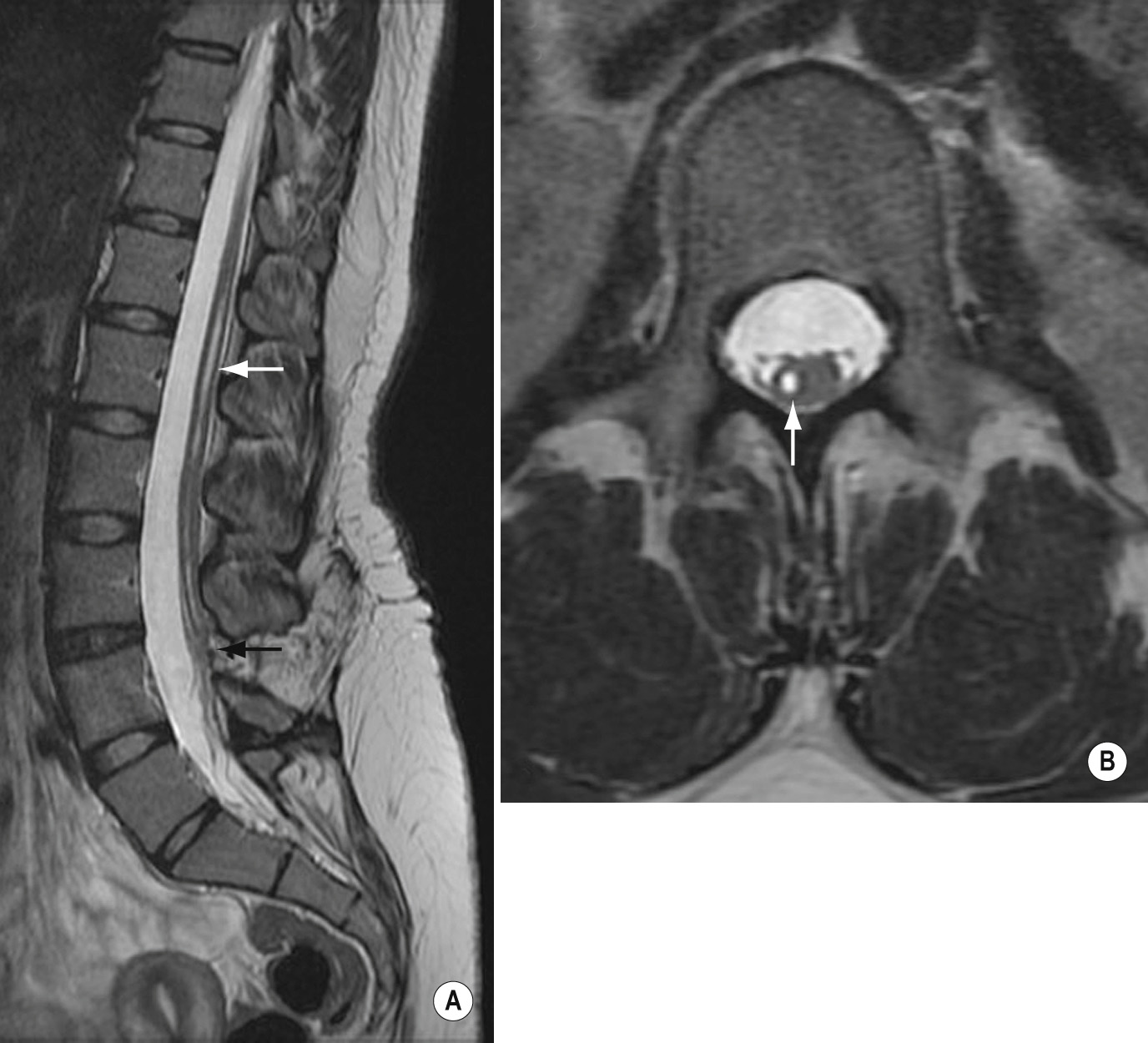 Syringohydromyelia, tethered cord, in a 21-year-old woman. Sagittal (A) and axial (B) T2W MR images show eccentric syringohydromyelia (white arrow) associated with tethered cord (black arrow). ■