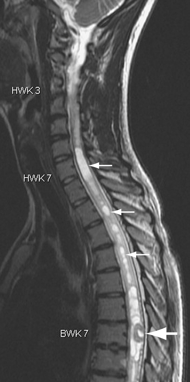 Syringohydromyelia associated with hemangioblastoma. T2W MR image shows the large sacculated syrinx extending in the thoracocervical spinal cord (thin white arrows), as well as thoracolumbar (not shown). Observe the nodule of the hemangioblastoma (thick white arrow). ■