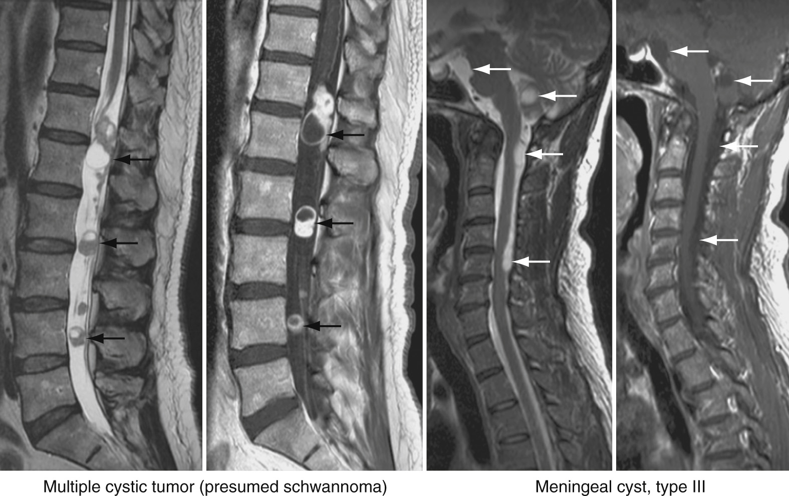 Cystic tumors usually show contrast enhancement (black arrows), whereas arachnoidal cysts (meningeal cyst type III) do not (white arrows). ■