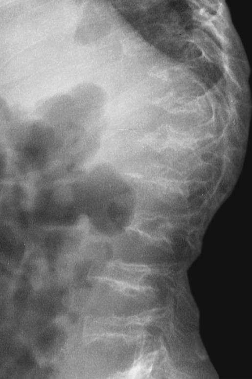 Morquio syndrome. There is universal vertebra plana, or flattened vertebral bodies. This can be distinguished from the ovoid vertebral bodies of Hurler syndrome and other mucopolysaccharidoses. The central anterior beaking of Morquio syndrome also differs from the anteroinferior beaking of Hurler syndrome and other mucopolysaccharidoses. ©35