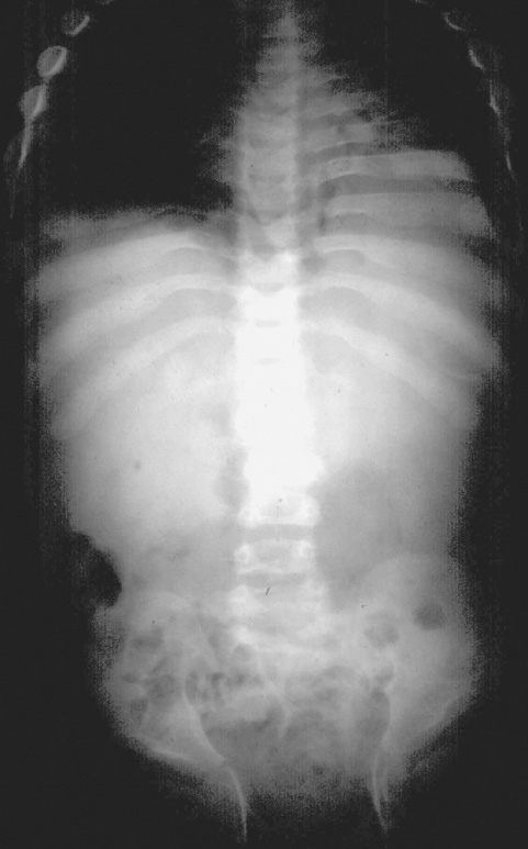 Hurler syndrome. The ribs are oar-shaped and wider than the intercostal spaces but become narrower in the paravertebral region. The iliac wings of the pelvis are flared, and the iliac body is constricted inferiorly. ©35