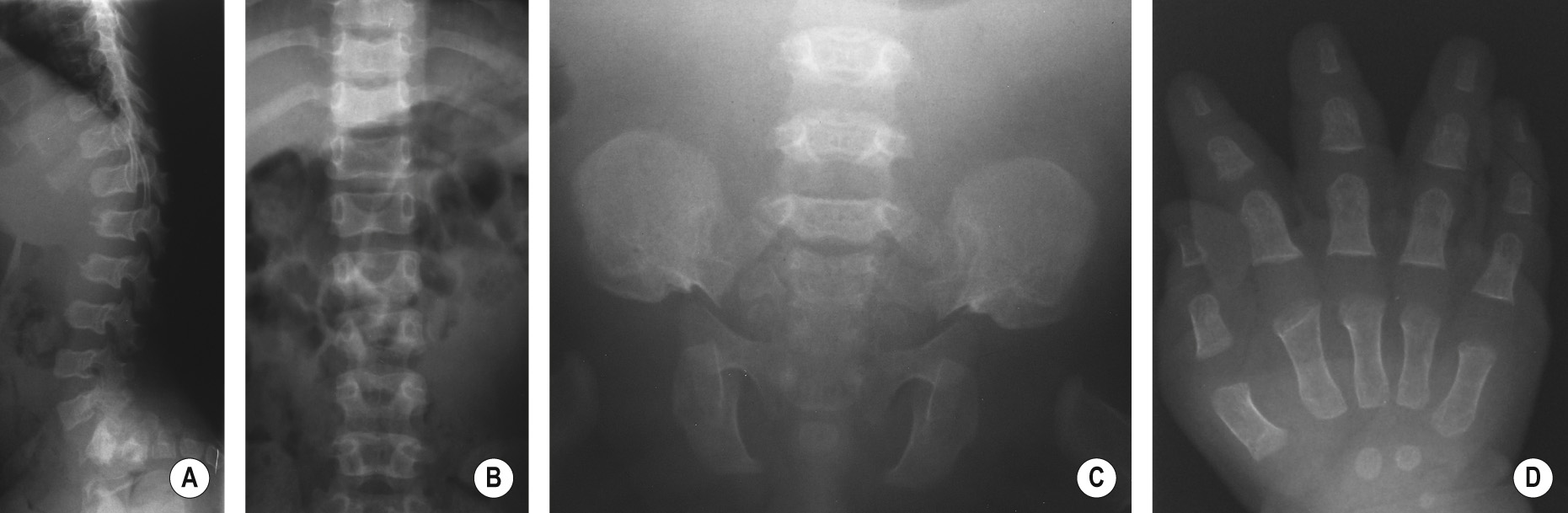 Achondroplasia. (A) Lateral radiograph of spine. Note posterior scalloping, bullet-shaped vertebral bodies, short pedicles and horizontal orientation of the sacrum. (B) Anteroposterior radiograph of the spine. There is abnormal narrowing of the interpedicular distances from L1 to L5 (should get progressively wider). This narrowing is not seen in infants. (C) Anteroposterior radiograph of the pelvis. Typical changes include horizontal acetabular roofs, trident acetabula and square iliac wings. (D) Anteroposterior radiograph shows a trident hand and bullet-shaped phalanges. ©35