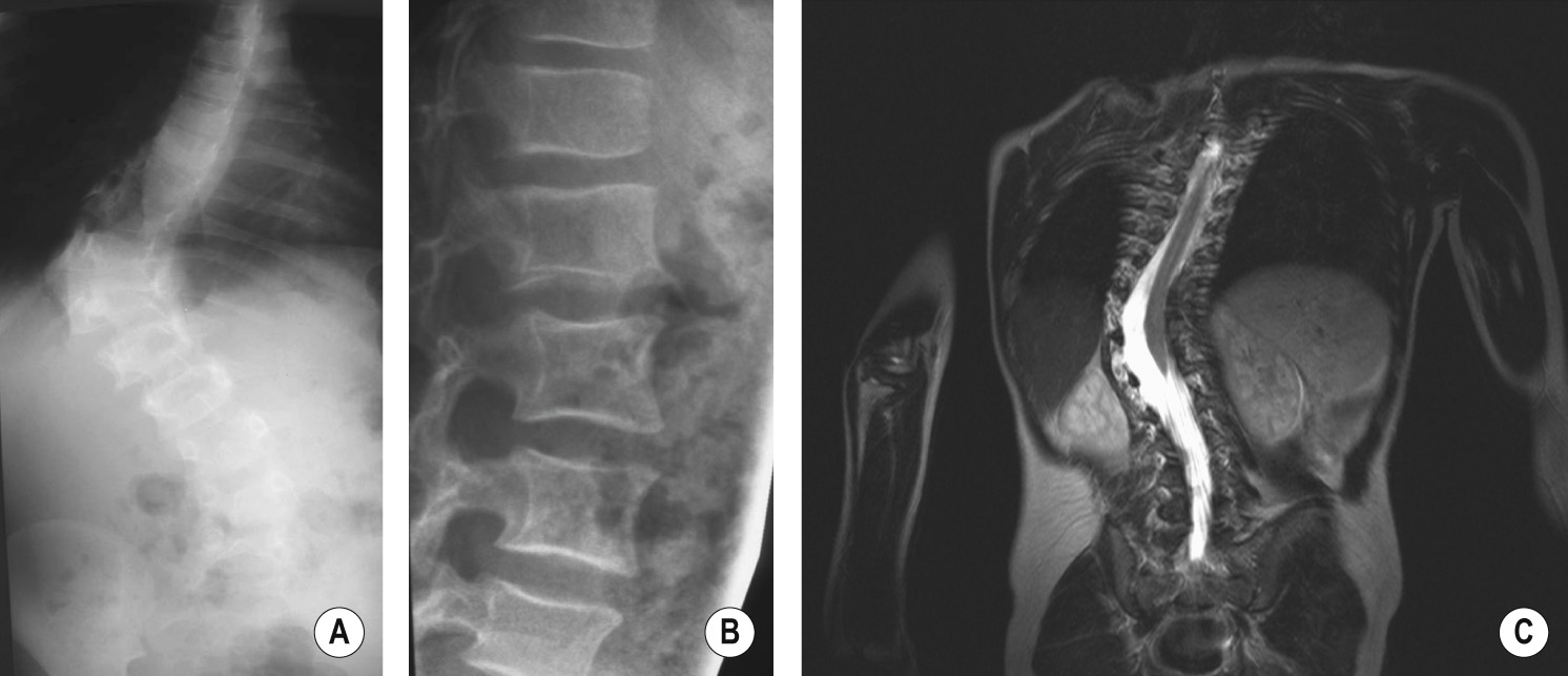 Type 1 neurofibromatosis with a short angular thoracolumbar curve as seen on an anteroposterior radiograph (A), lateral radiograph (B) and coronal T2WI (C). There is scalloping of the posterior vertebral body wall and enlargement of the exit foramen. The MR image demonstrates dural ectasia with a widened spinal canal. ©35