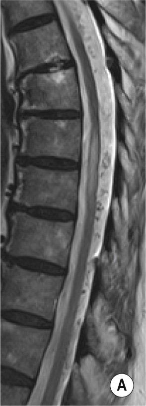 Spinal dural arteriovenous fistula (SDAVF). (A) Sagittal T2 demonstrating intrinsic T2 cord hyperintensity in keeping with spinal cord oedema. Serpiginous flow voids of the dilated perimedullary veins are more prominent on the dorsal surface and appear more conspicuous on (B) the CISS sequence. (C) Sagittal reconstruction of TWIST sequence at the level of the thoracic aorta suggests presence of a fistula in the upper thoracic cord (arrow). A SDAVF was confirmed by DSA (D) following selective catheterization of left supreme intercostal trunk which demonstrated the fistulous point (arrow). **