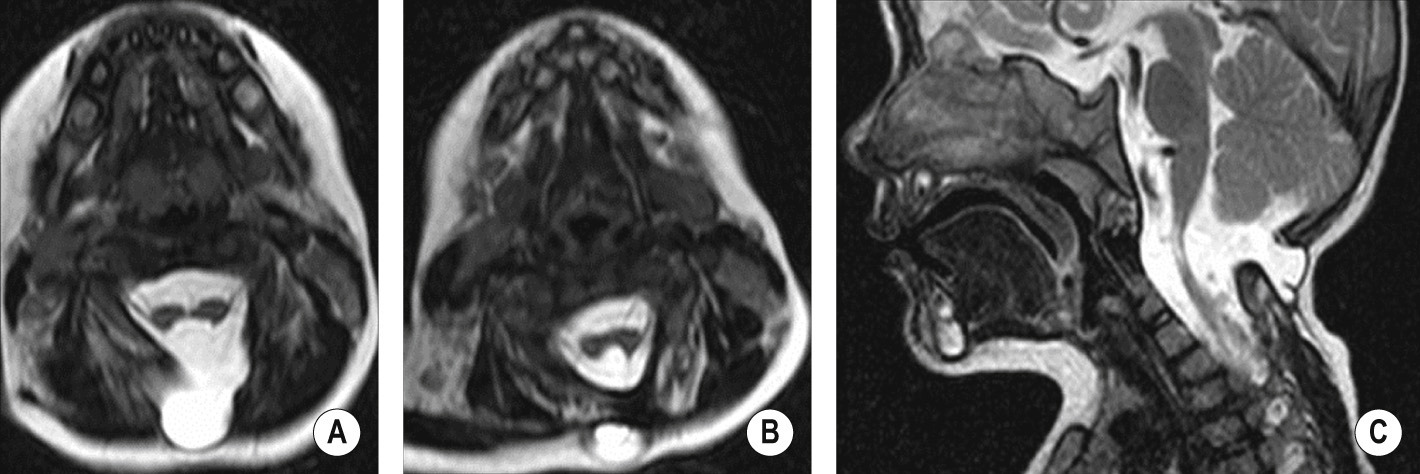 Cervical spinal cord diastematomyelia type II with associated craniocervical meningocele. (A) The meningocele is seen herniating through a bony defect in the vertebral posterior elements. (B) Axial T2WI shows that the cord has split into two hemicords. The apparent signal abnormality is in fact normal cerebrospinal fluid interspersed between the two hemicords. These reunite inferiorly. (C) Sagittal T2WI appears to show signal abnormality and thinning of the spinal cord, and is the clue to the diastematomyelia seen on the axial images. *