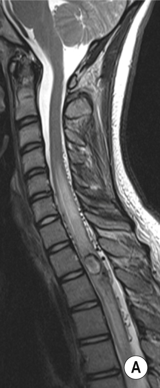 Spinal arteriovenous malformation (SAVM). (A) Sagittal T2 MRI demonstrating an intramedullary lesion at T1/2 with a hypointense rim in keeping with haemosiderosis. Note the cord expansion and associated cord oedema. Note also the serpiginous flow voids, which are more prominent on the dorsal surface of the cord. These are much more conspicuous on heavily weighted T2 sequences such as (B) CISS sequence, right parasagittal slice. (C) Selective catheterization of the right vertebral artery on DSA confirms the presence of an arteriovenous malformation. Note the intranidal aneurysm (arrow). **