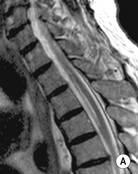 Acute spinal cord ischaemia with acute onset of symptoms in a male patient following aortic repair. (A) On sagittal T2 of the cervicothoracic spine linear hyperintensity is shown in the ventral part of the spinal cord extending over three vertebral segments. (B) Axial T2 demonstrates ‘snake's eyes’ appearance, indicating involvement of the ventral grey matter of the spinal cord. (C) Sagittal trace DWI demonstrates high signal consistent with restricted diffusion. **