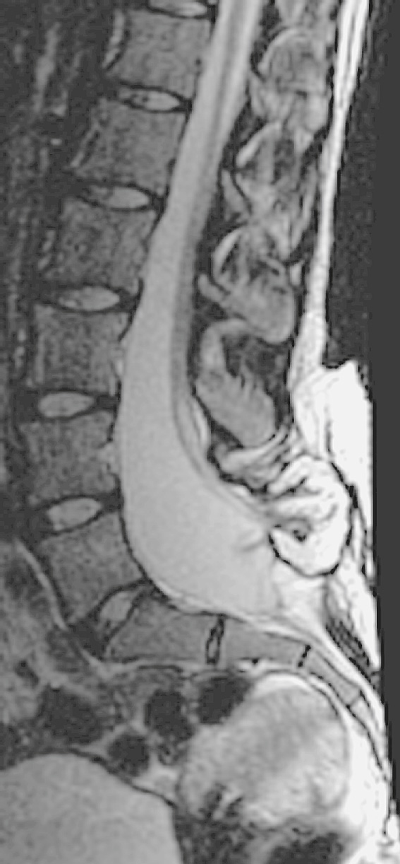 Myelomeningocele. Note the neural placode, enlarged spinal canal and spinal dysraphism. There is also a distal syrinx. +