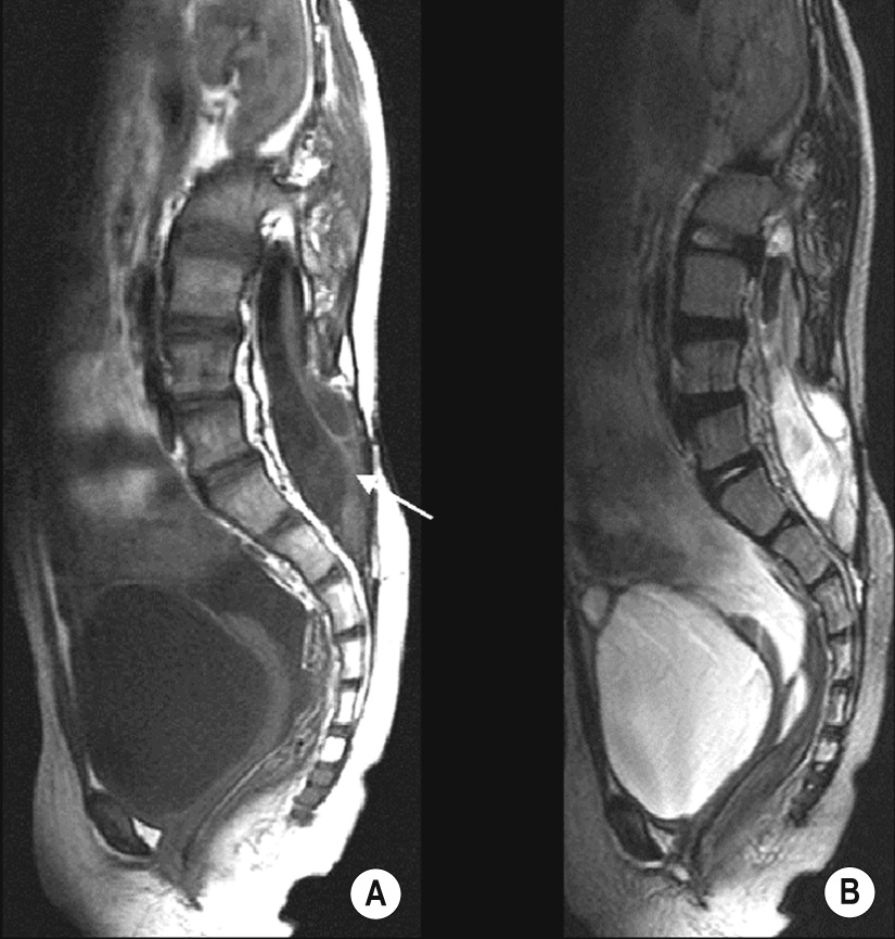 Repaired myelomeningocele in a child with Chiari II malformation. Sagittal T1WI (A) and T2WI (B) showing that the neural placode terminates inferiorly in the meningeal sac (arrow). The lumbosacral posterior vertebral elements have not formed. *