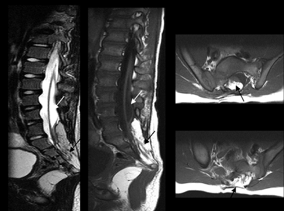 Closed spinal dysraphism. The spinal cord is too low and the neural placode terminates at the lumbosacral junction in a lipomyelocele (black arrows). There is an associated spinal cord syringomyelic cavity (white arrows). The posterior elements are deficient and everted. *