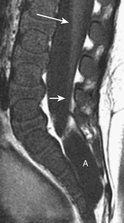 Tethered cord (long arrow), thick filum and lipoma (short arrows) and sacral extradural arachnoid cyst (A) on sagittal T1WI. §