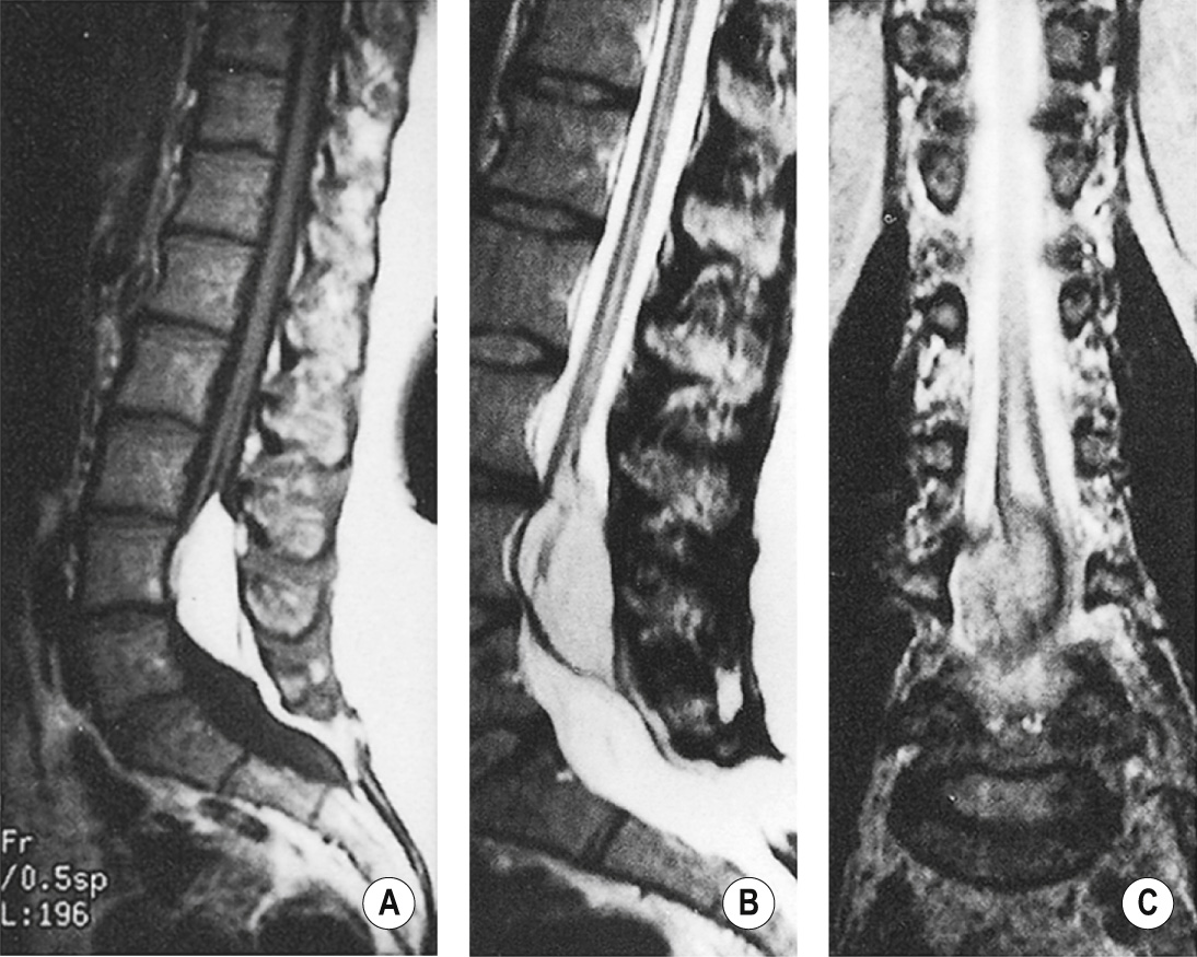 Lipomyelomeningodysplasia. Sagittal (A) T1WI and (B) T2WI and coronal (C) T2WI showing the lipoma, low position of the spinal cord and a cavity in the distal spinal cord. *