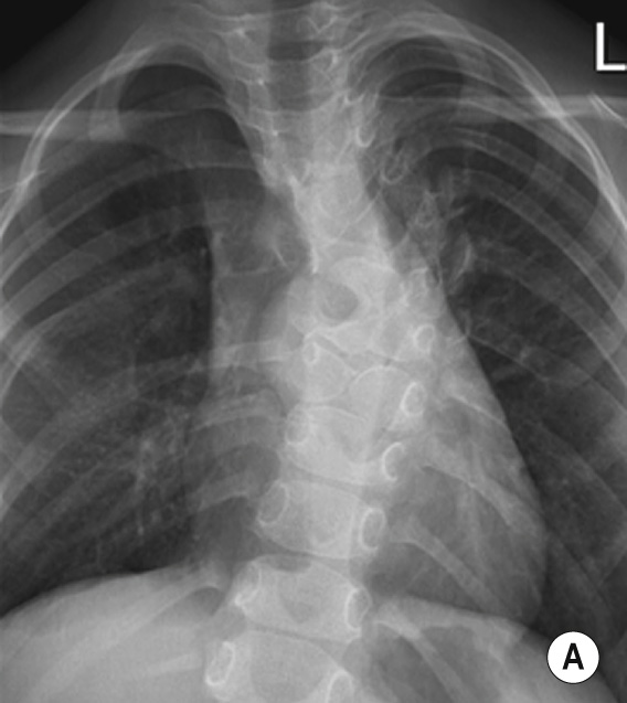 Neuroenteric cyst. (A) Chest radiograph and (B) coronal multiplanar reformat of CT thorax in same patient. There is a complex segmentation anomaly within the mid-thoracic region associated with kyphoscoliosis, consisting of congenital fusion and butterfly vertebrae. There is an associated right paraspinal mass. (C) Axial CT through the lesion shows that it is in direct continuation with the spinal canal through a large ventral bony defect. (D) Axial T2 and (E) axial T1 at the level of the lesion demonstrating that the lesion is cystic. (F) Axial T2 through the bony defect demonstrates the direct continuity of the cyst with the spinal canal. The appearances are in keeping with a neuroenteric cyst. The thoracic cord is also seen to extend through the bony defect. The neural tissue is seen to lie to the left of the neuroenteric cyst. (G) Sagittal T2 in the right paramidline demonstrating the direct communication with the spinal canal. **