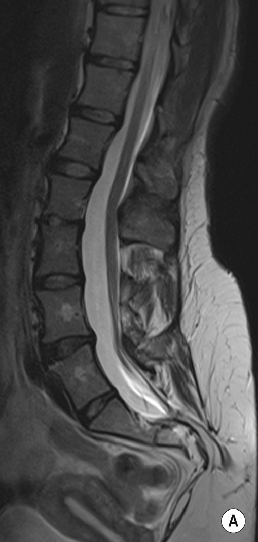 Diastematomyelia. (A) Sagittal T1 of the lumbar spine demonstrating an ill-defined low-lying conus at the L4–L5 level. The nerve roots are tethered caudally and herniate through a bony defect in the posterior elements. There is agenesis of the lower sacrum and of the coccyx. (B) Axial T2 through the lower thoracic spine clearly demonstrates the split cord. (C) Axial T1 through the lower dural sac demonstrates an intradural extramedullary left-sided high signal-intensity lesion. This suppresses on (D) fat-suppressed axial T2 at the same level. The appearances are in keeping with a lipoma. **