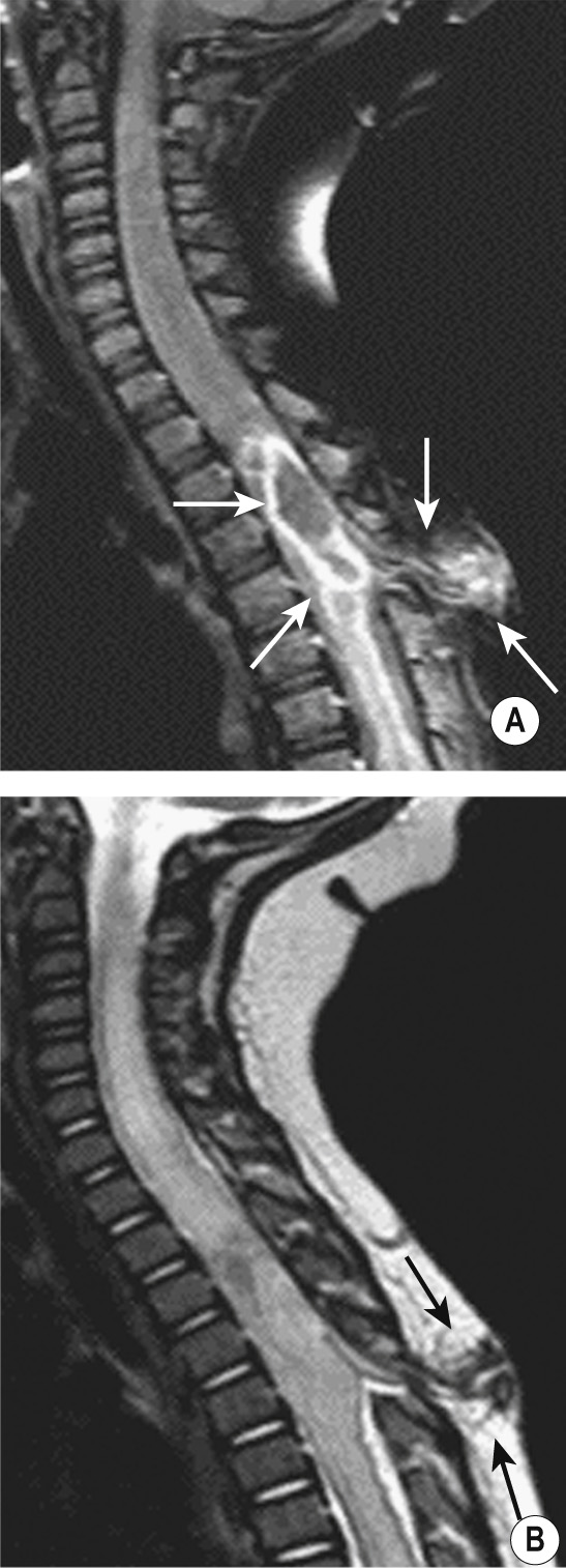 Thoracic dermal sinus (posterior black and white arrows in (A) and (B)) and a cyst with an enhancing abscess (anterior white arrows in (B)) with cord oedema on the sagittal T1WI + Gad (A) and T2WI (B). §