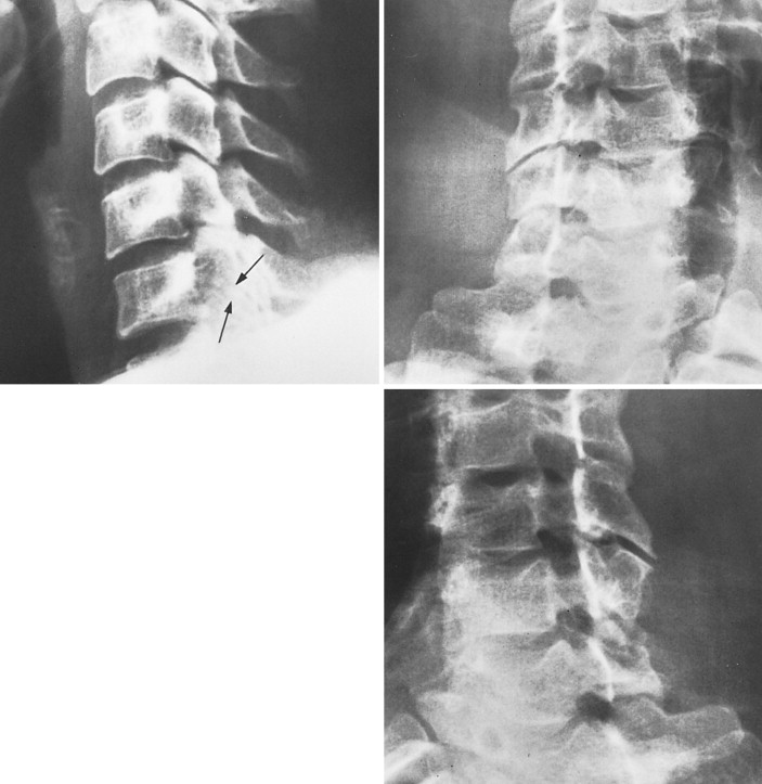 FIGURE 3S-86, Top left, The lateral elements of C6 projected slightly caudad show two apophyseal joints that were misinterpreted as fractures. Top right and bottom, Oblique projections show no abnormality.