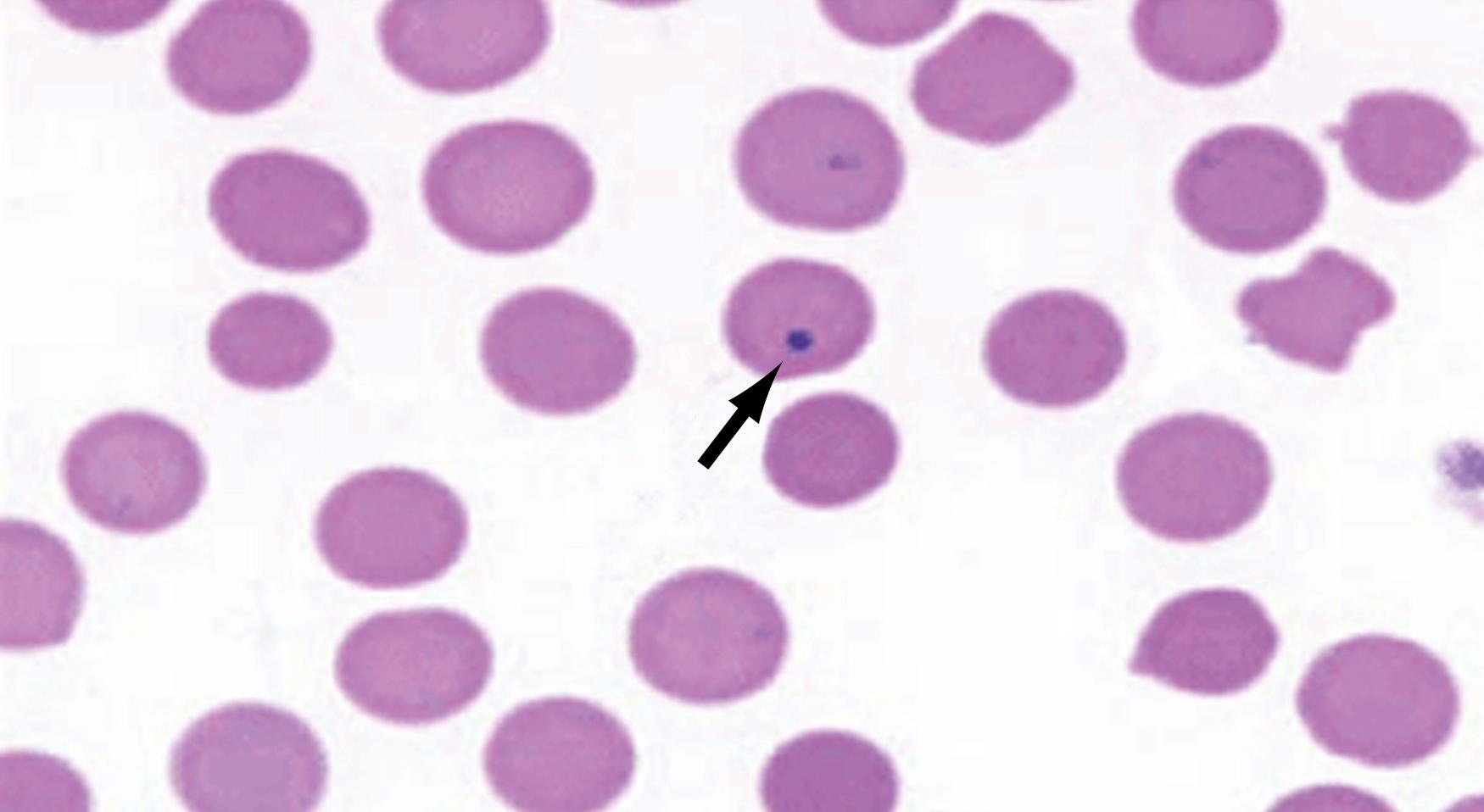 Fig. 57.6, The presence of Howell-Jolly bodies (arrow) on the peripheral blood smear is suggestive of asplenia or hyposplenism.