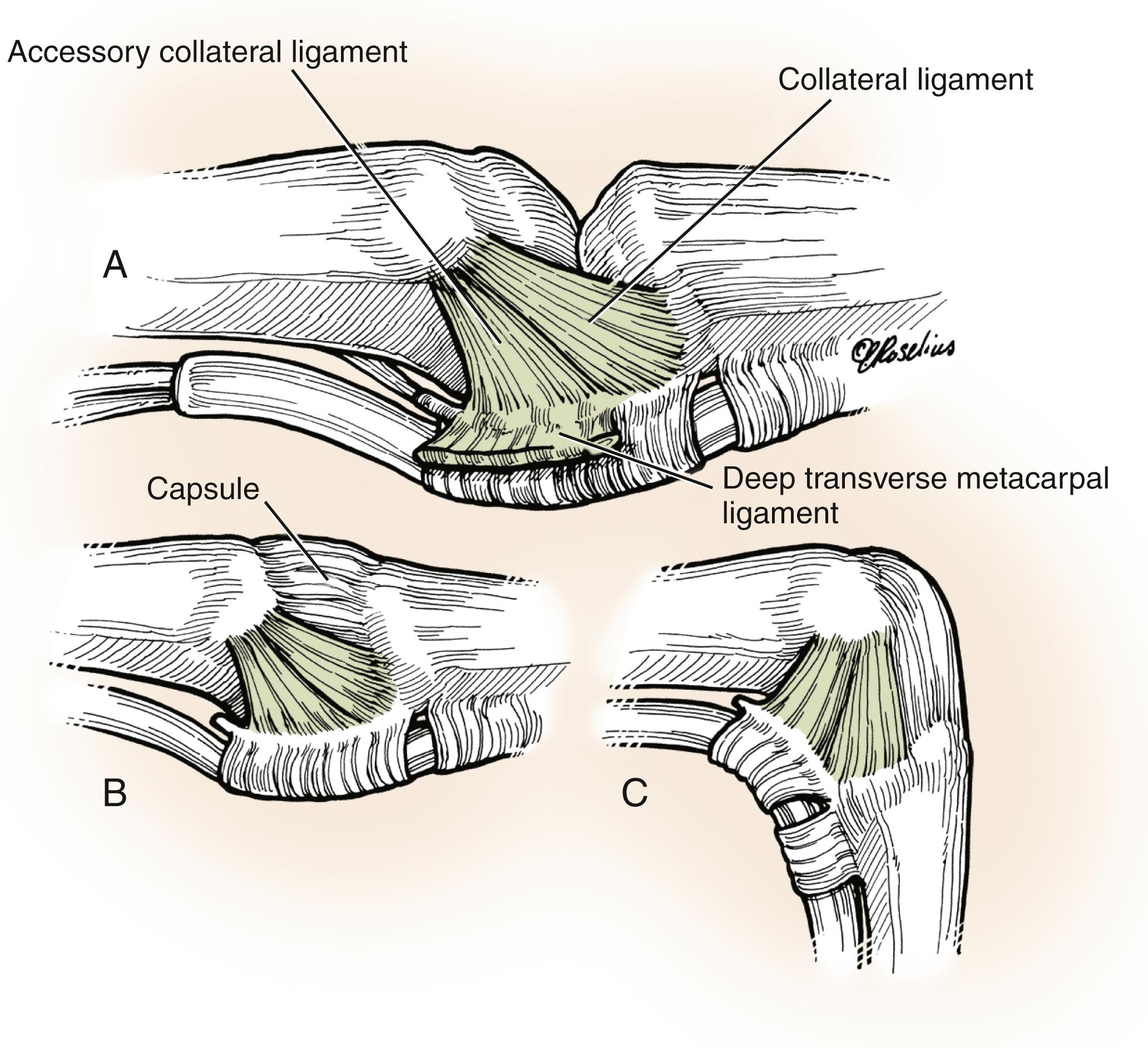 Fig. 10.1, Ligamentous anatomy of the metacarpophalangeal (MP) joint. (A), The MP joint has an accessory and a proper collateral ligament on the radial and ulnar aspect of the joint. A capsule covers the dorsal aspect of the joint. In extension, the proper collateral ligament is lax, as is the dorsal capsule (B) , whereas in flexion, the proper collateral ligament and dorsal capsule are taut (C) .