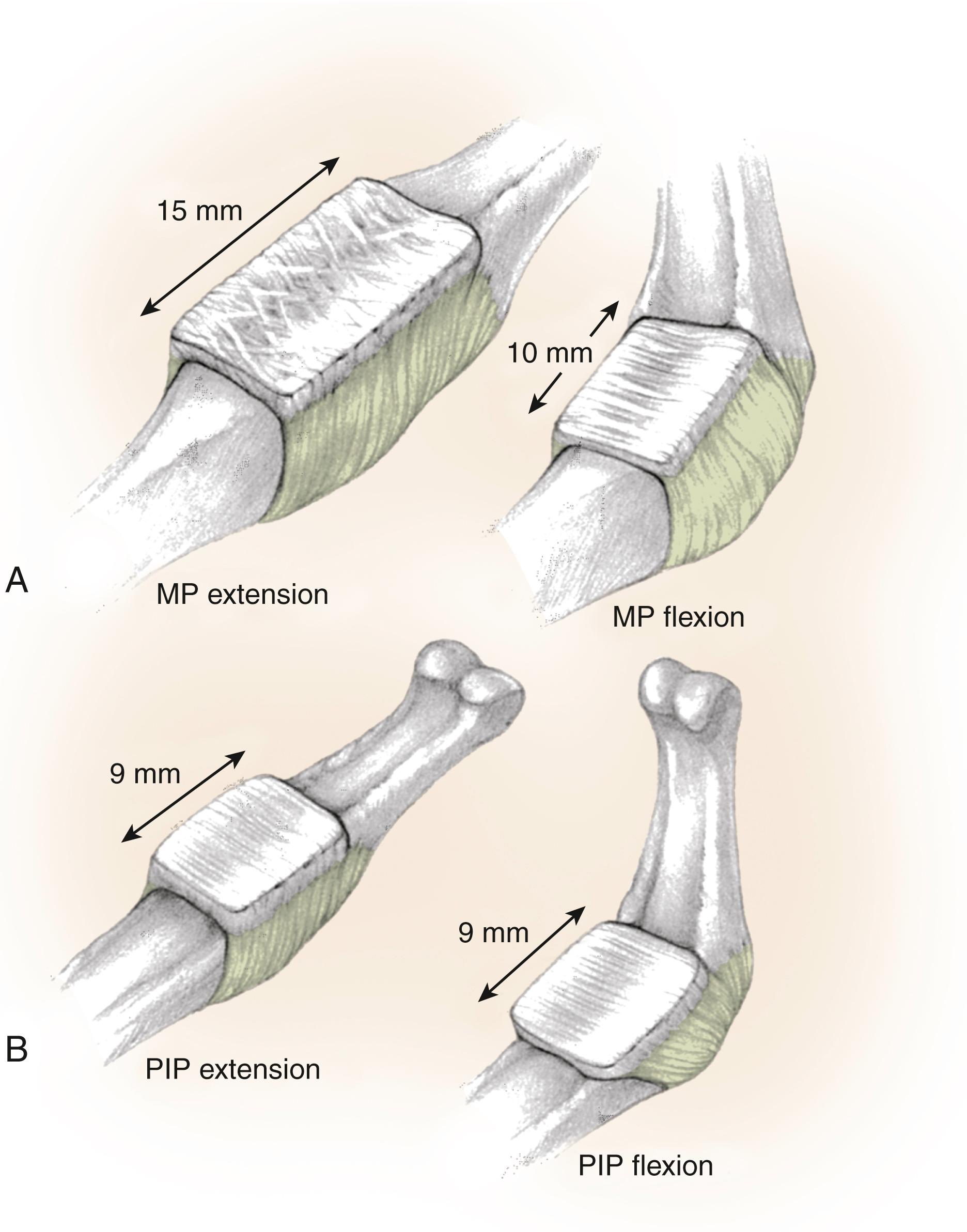 Fig. 10.3, The volar plate. A, The volar plate of the metacarpophalangeal (MP) joint is composed of crisscrossing fibers that have the ability to collapse from the fully extended to the fully flexed position. In flexion, the volar plate collapses from a third to a half of its length in full extension. The volar plate pocket behind the MP volar plate is smaller than at the proximal interphalangeal (PIP) joint; thus there are no checkreins. (Sagittal microscopic views demonstrate these bundles of fibers compared with the more homogeneous collagenous arrangement in the PIP volar plate.) B, The PIP joint volar plate is similar to a unit in a suit of armor. It slides proximally and distally and protects the joint. The volar plate is thick, which allows extreme external loading over the joint. The pocket behind the proximal volar plate is large. The excursion of the volar plate between flexion and extension is substantial and any collapse of the volar plate itself between extension and flexion is minimal. Any limitation or fixation of the proximal volar plate, as with the development of checkreins, produces a significant restriction in extension of the PIP joint.