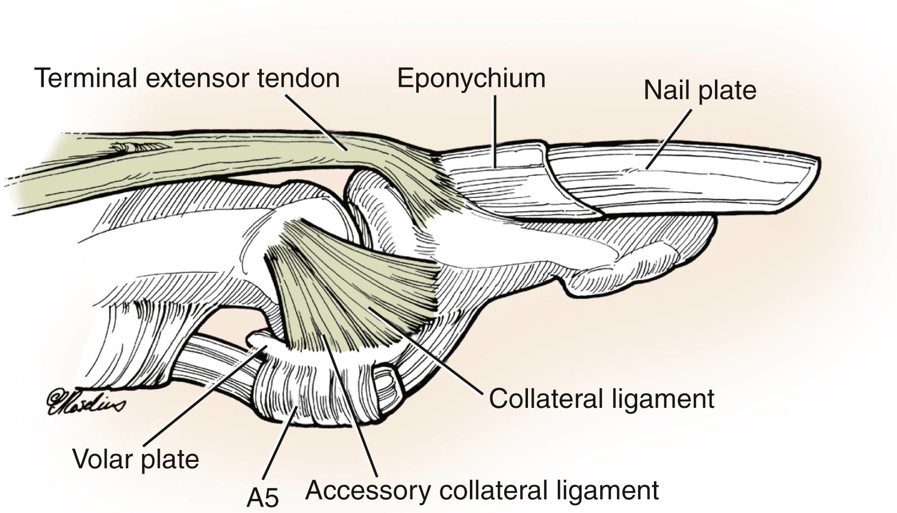 Fig. 10.4, Anatomy of the dorsal interphalangeal (DIP) joint. The DIP joint is bound on the radial and ulnar side by the accessory and proper collateral ligaments. The dorsal aspect of the joint is covered by the terminal extensor tendon, which inserts onto the distal phalanx.