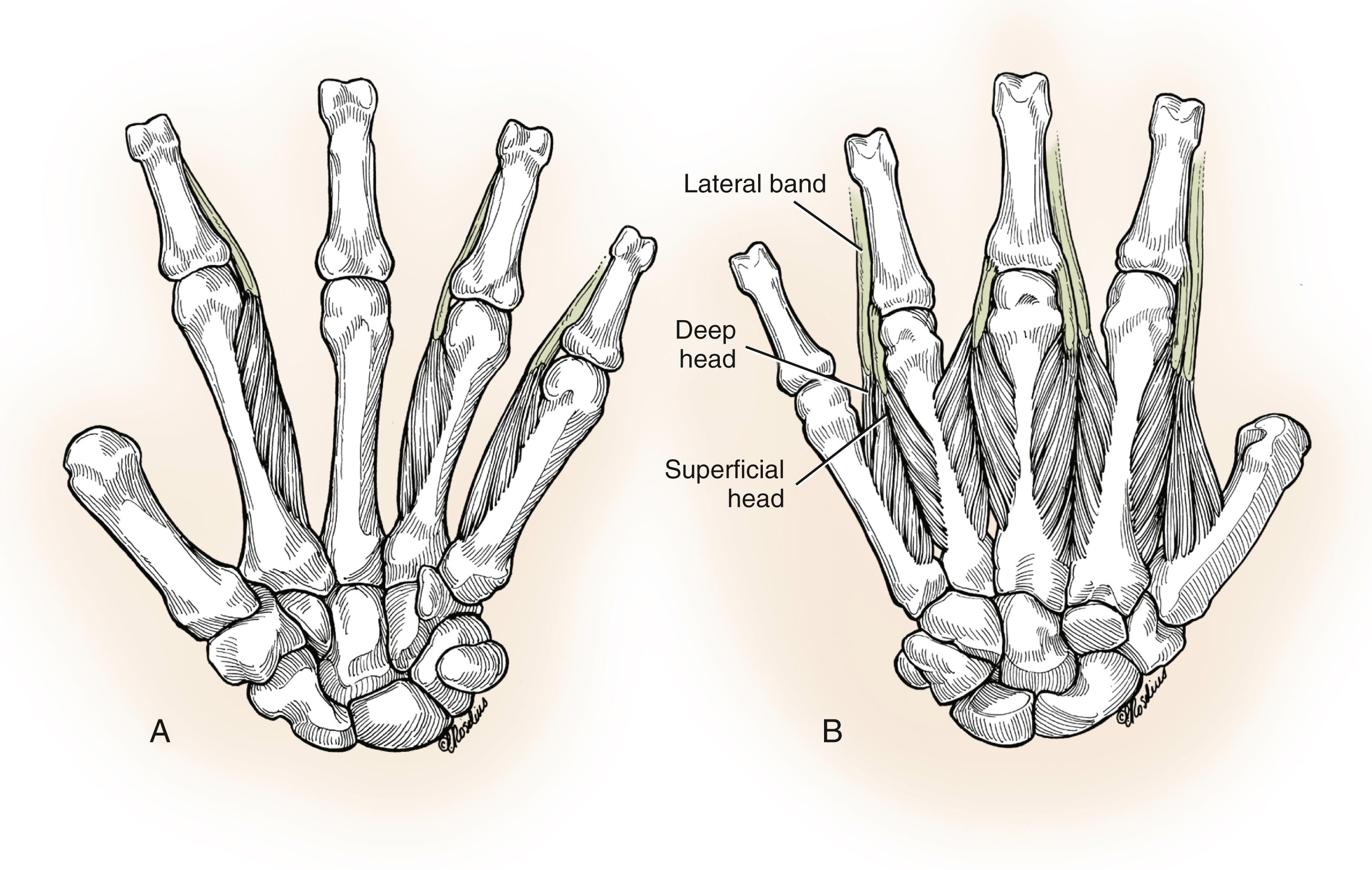 Fig. 10.5, Anatomy of the interosseous muscles. A, The palmar interosseous muscles are located on the ulnar side of the index metacarpal and on the radial aspect of the ring and small metacarpals and extend to the lateral bands of their respective digits. The middle finger has no palmar interosseous muscles. B, The dorsal interosseous muscles are bipennate muscles originating from the adjacent metacarpals of each web space.