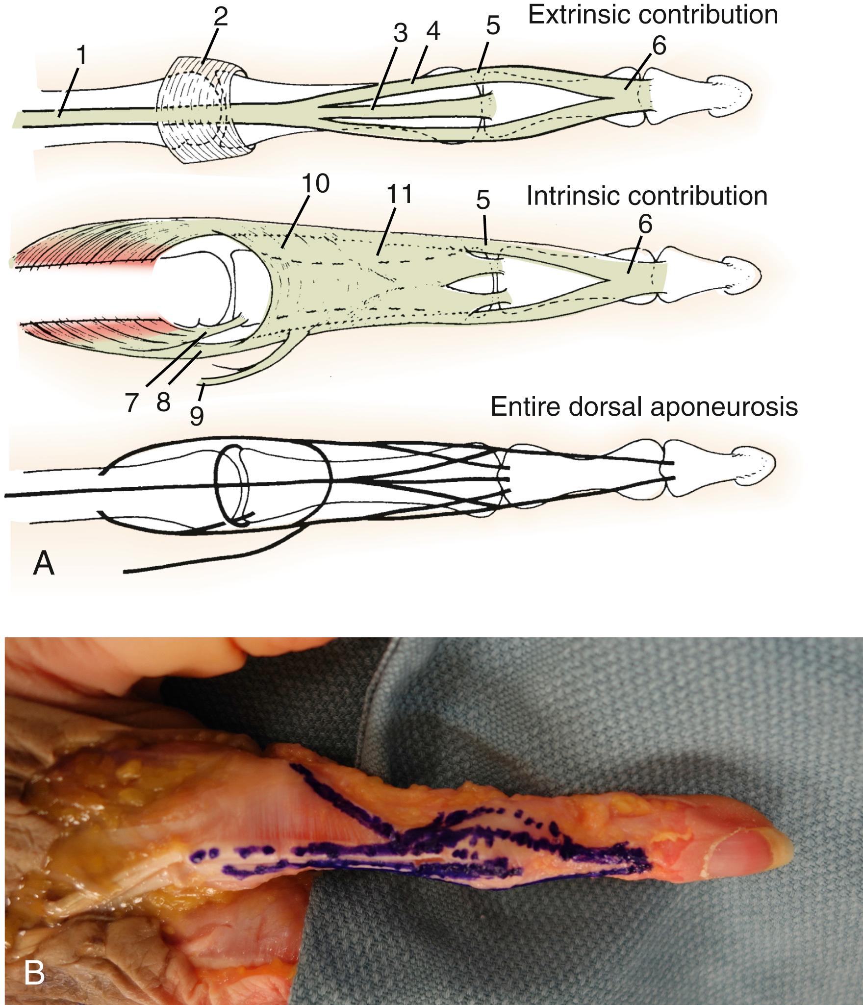 Fig. 10.6, Lateral view of the dorsal aponeurosis of the finger. A, Diagrammatic representation of the extrinsic contribution, the intrinsic contribution, and the entire dorsal aponeurosis of the finger. 1, Extensor tendon; 2, sagittal band; 3, central slip; 4, lateral slip; 5, conjoined lateral band; 6, terminal tendon; 7, superficial head and medial tendon of the dorsal interosseous; 8, deep head and lateral tendon of the dorsal interosseous; 9, lumbrical muscle and tendon; 10, transverse fibers of the dorsal aponeurosis; 11, oblique fibers of the dorsal aponeurosis. B, Dissected specimen showing the dorsal aponeurosis of the finger. The cardboard arrow points to the lateral band lying between the lateral tendon and the conjoined lateral band. The transverse and oblique fibers are dotted. The central slip, lateral slip, lateral band, and conjoined lateral band are identified by the continuous dark lines. The sagittal bands lie proximal to the dotted transverse fibers of the dorsal aponeurosis.